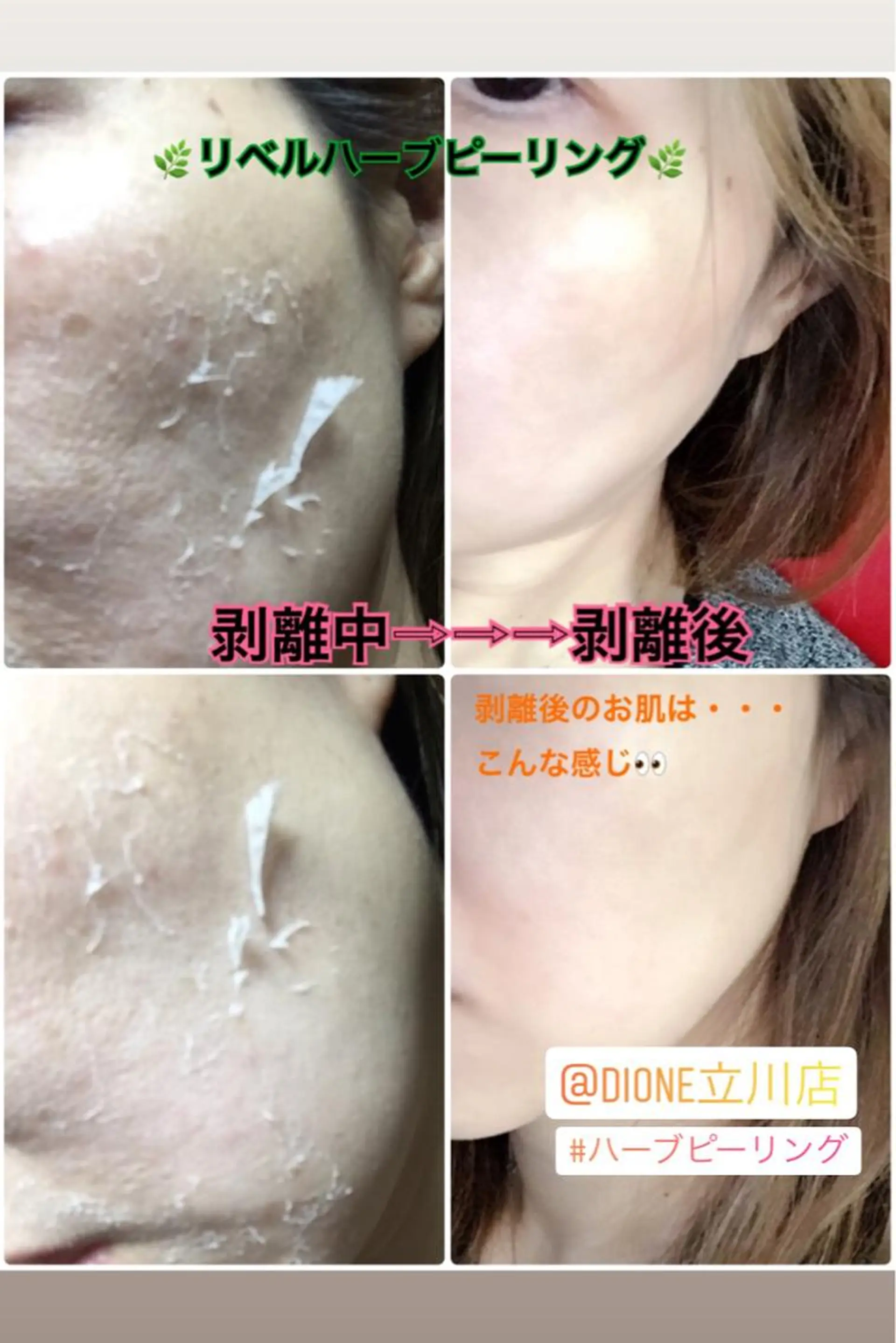 エステ 【リベルハーブピーリング認定店】敏感肌・美白脱毛専門店Dione立川店所属・Dione 立川店のエステ・リラクイメージ