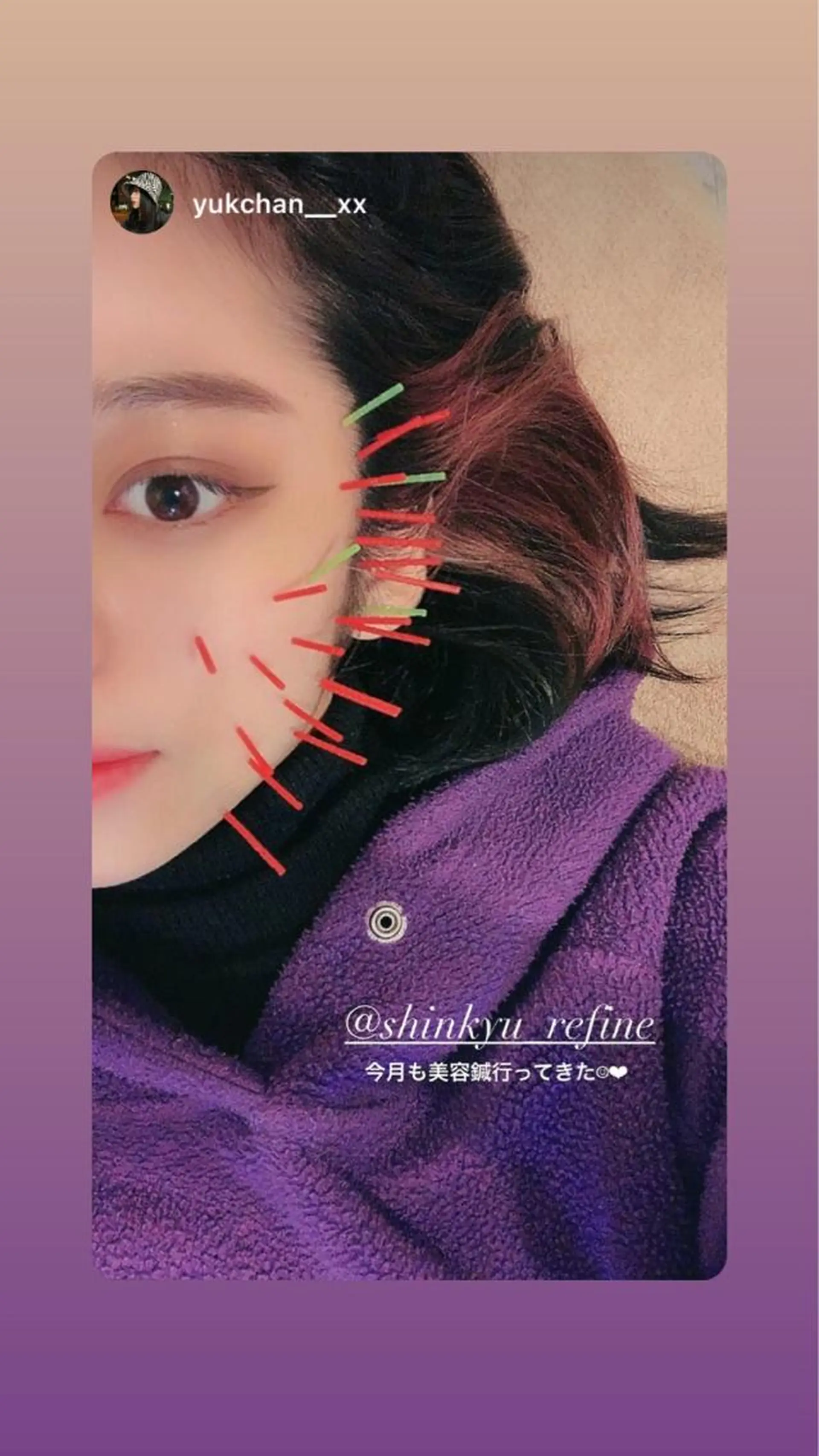 鍼灸整骨院Refine所属・鍼灸 Refineのその他イメージ