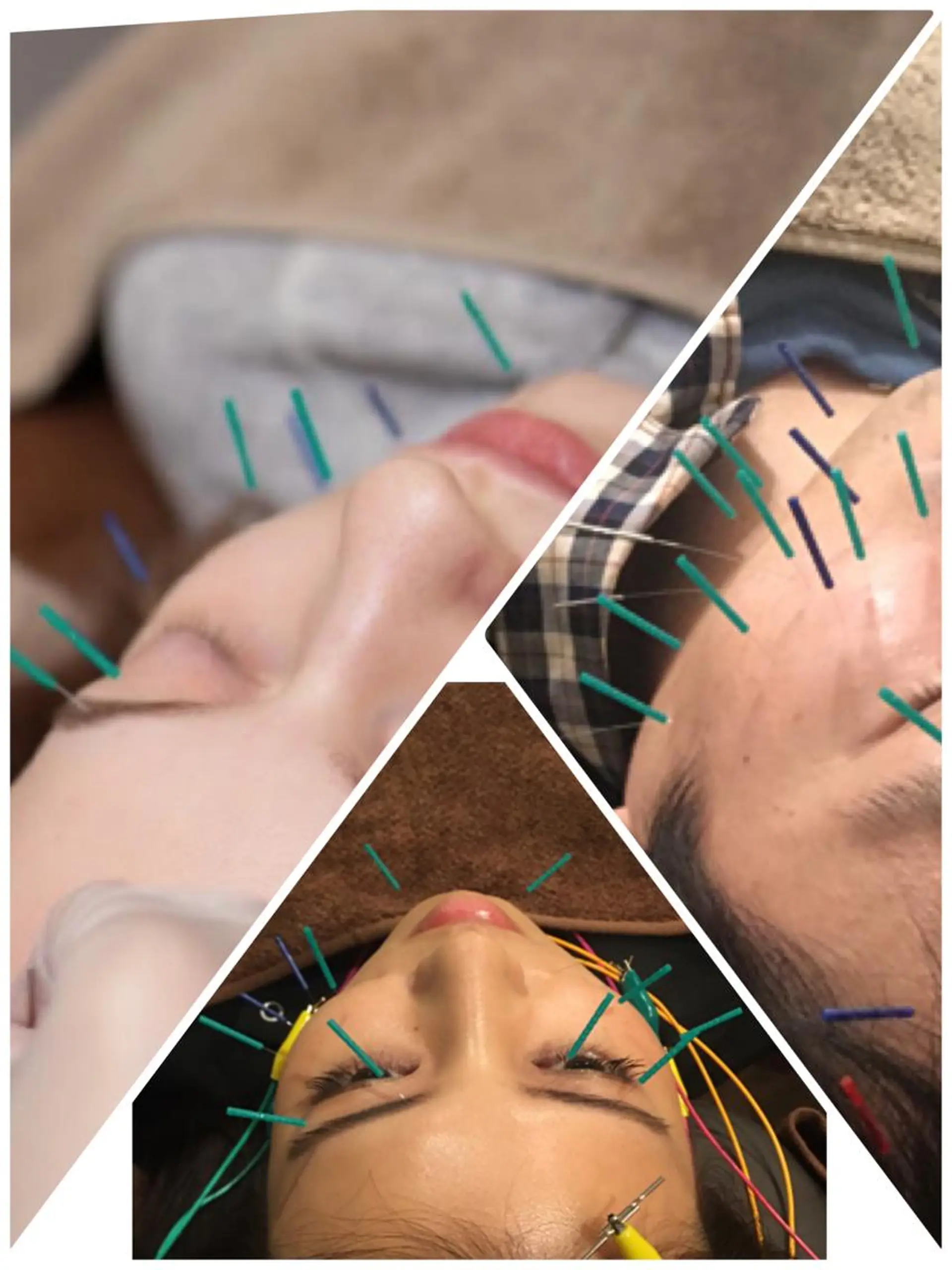 表参道鍼灸院K 美容鍼🔮ララピールのエステ・リラクイメージ