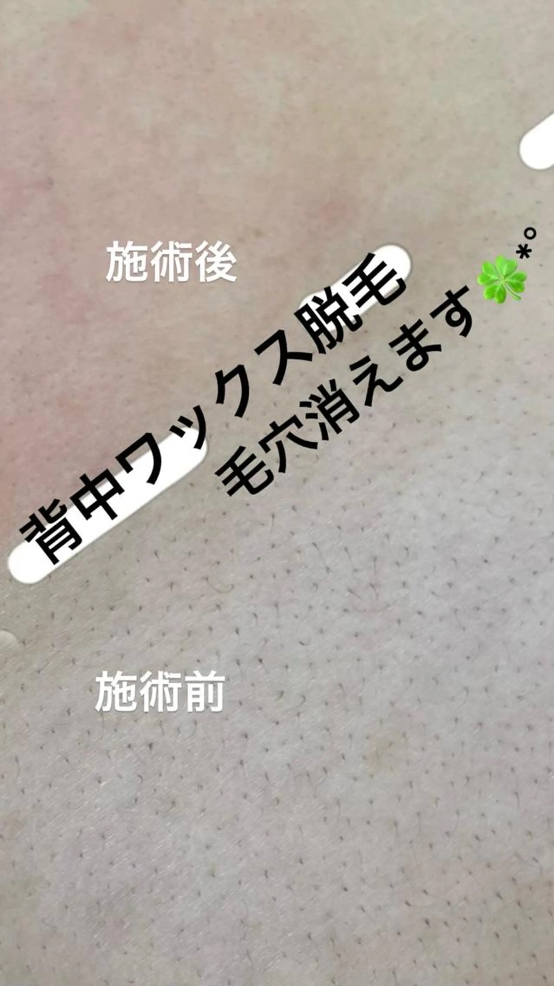 脱毛 KIRAN 山﨑のエステ・リラクイメージ