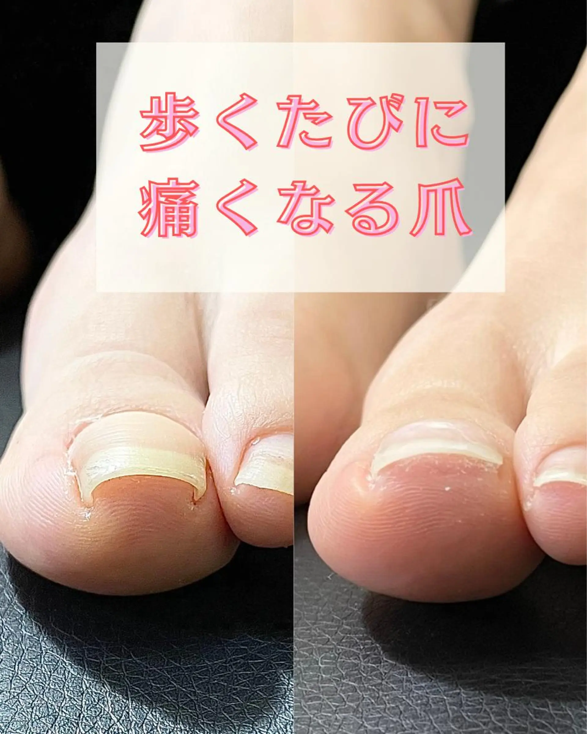 ネイル 深爪・巻き爪 専門サンセリテのネイルデザイン