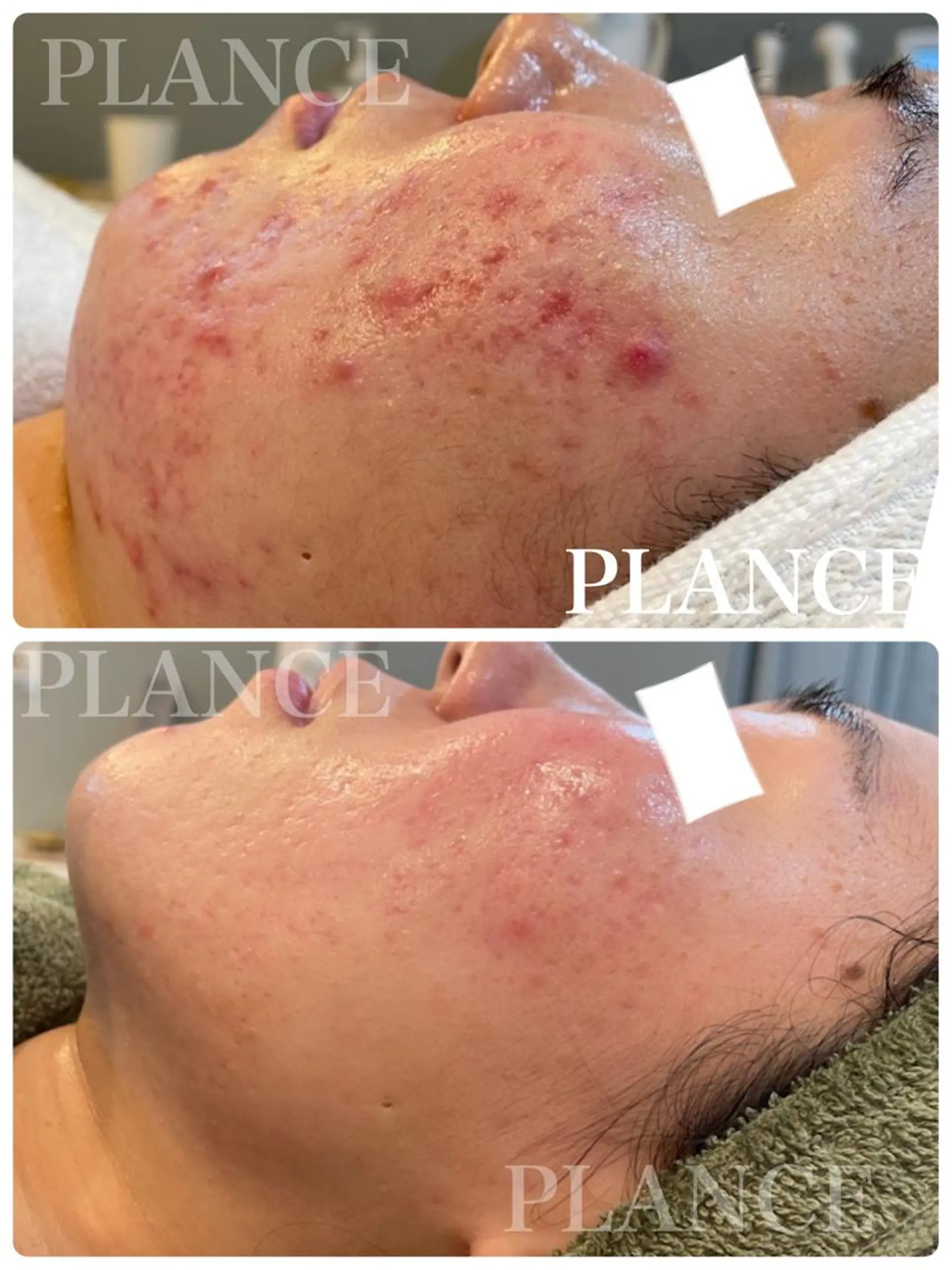 エステ フェイシャル専門 肌質改善/プランスのエステ・リラクイメージ