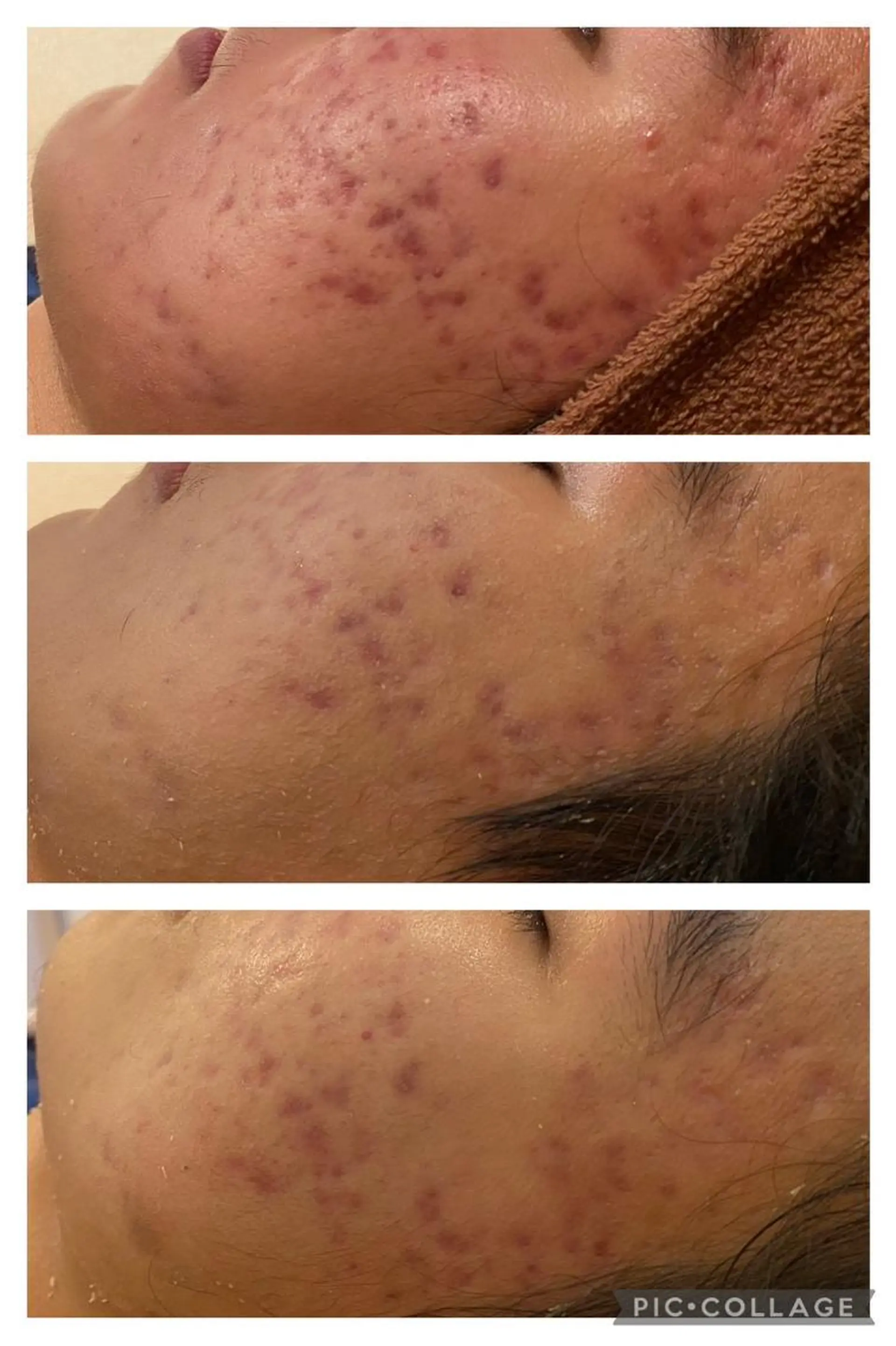 エステ リラク 6万人の美肌実績🔥 最短ニキビ改善のエステ・リラクイメージ