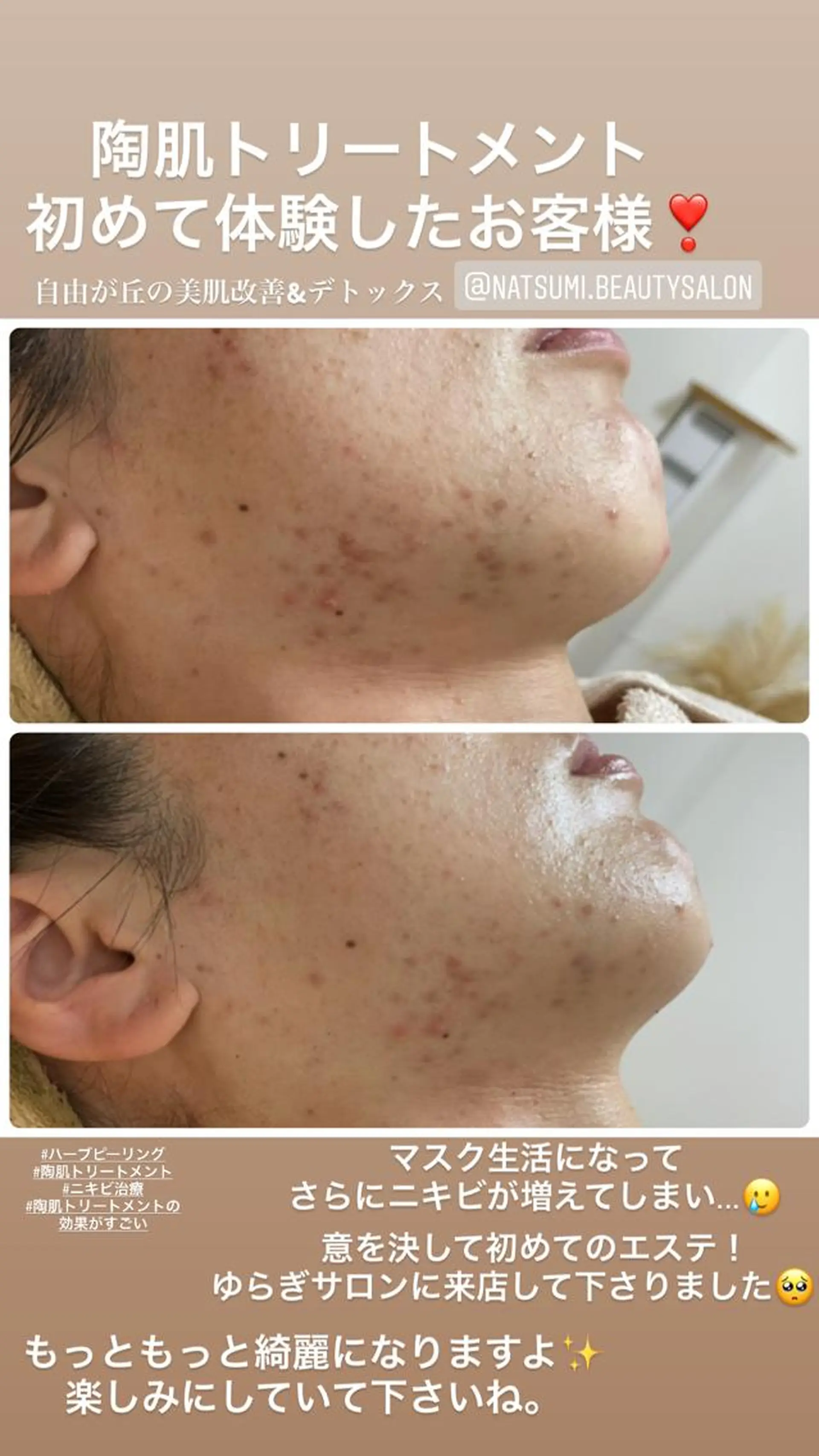 ネイル マツエク・マツパ エステ ニキビ・毛穴改善 🌿ハーブピーリングのエステ・リラクイメージ
