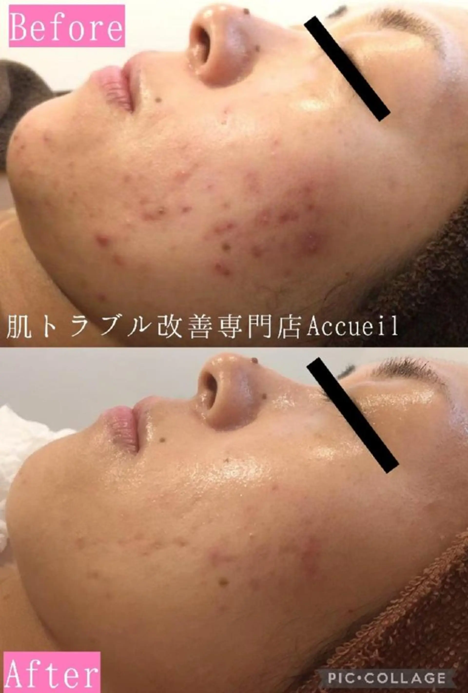 学生ニキビ改善🍀 優しい肌質改善のエステ・リラクイメージ