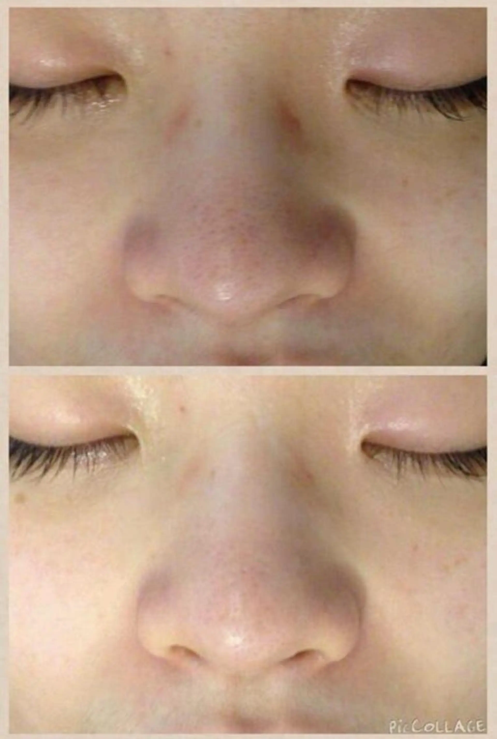 都内で出来る肌管理！ 最短ニキビ改善のエステ・リラクイメージ