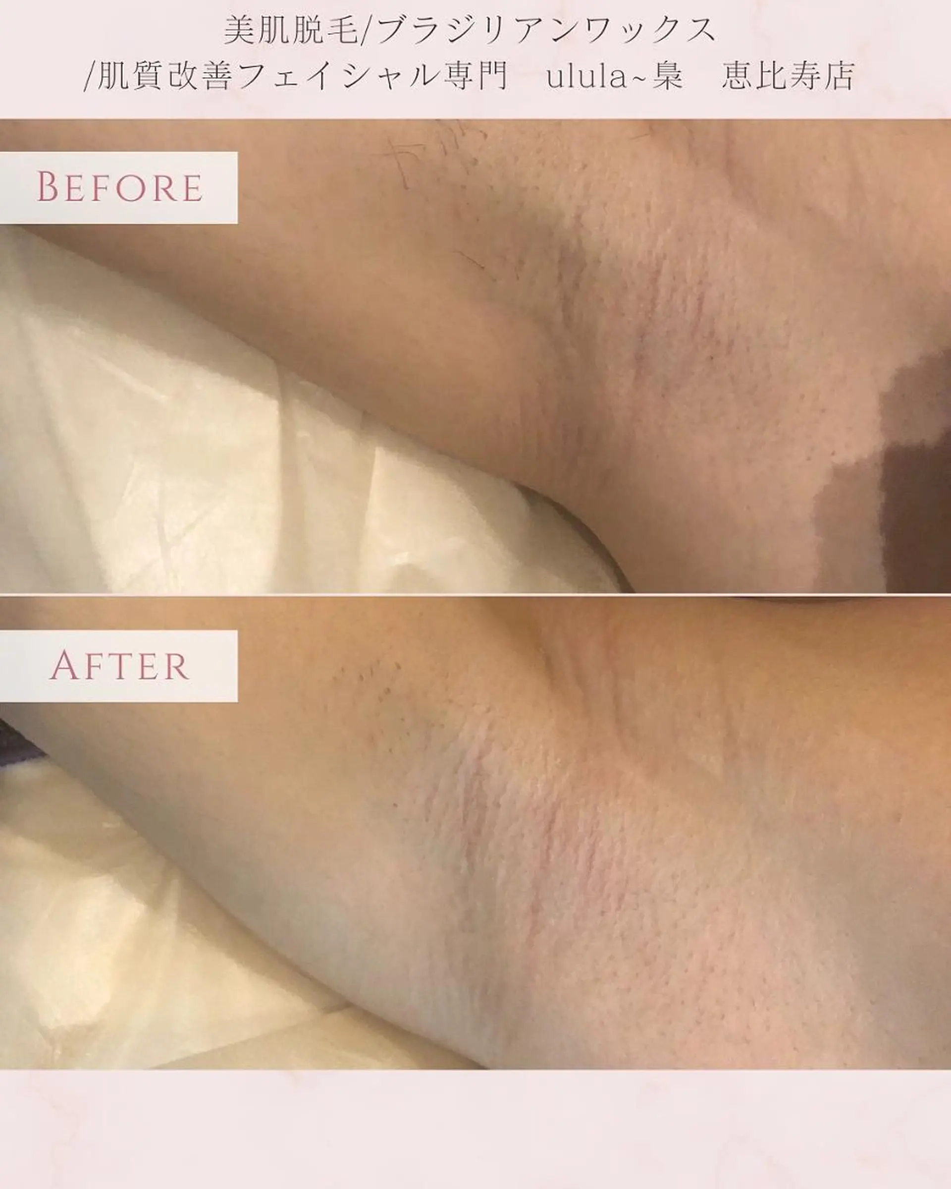 美肌脱毛/肌質改善 《ulula～梟》のエステ・リラクイメージ