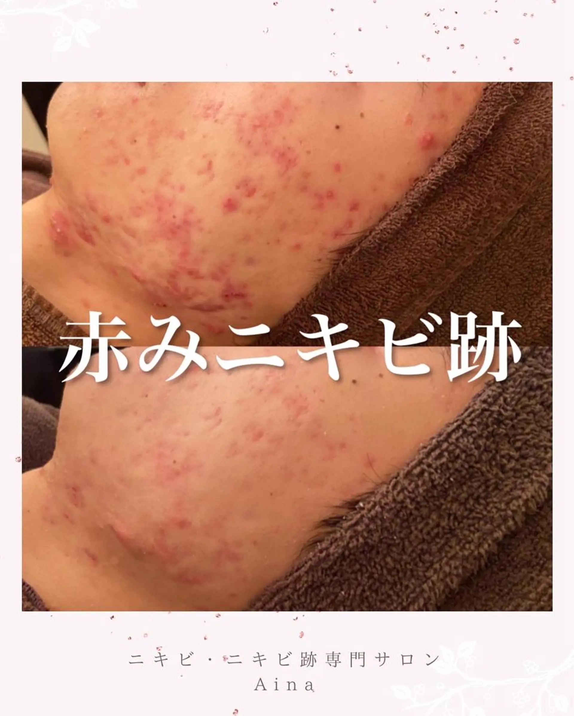 セミロング パーマ ヘアアレンジ キッズ ネイル マツエク・マツパ アイブロウ ブルー 赤色 エステ リラク ニキビ跡専門サロン Ainaのエステ・リラクイメージ