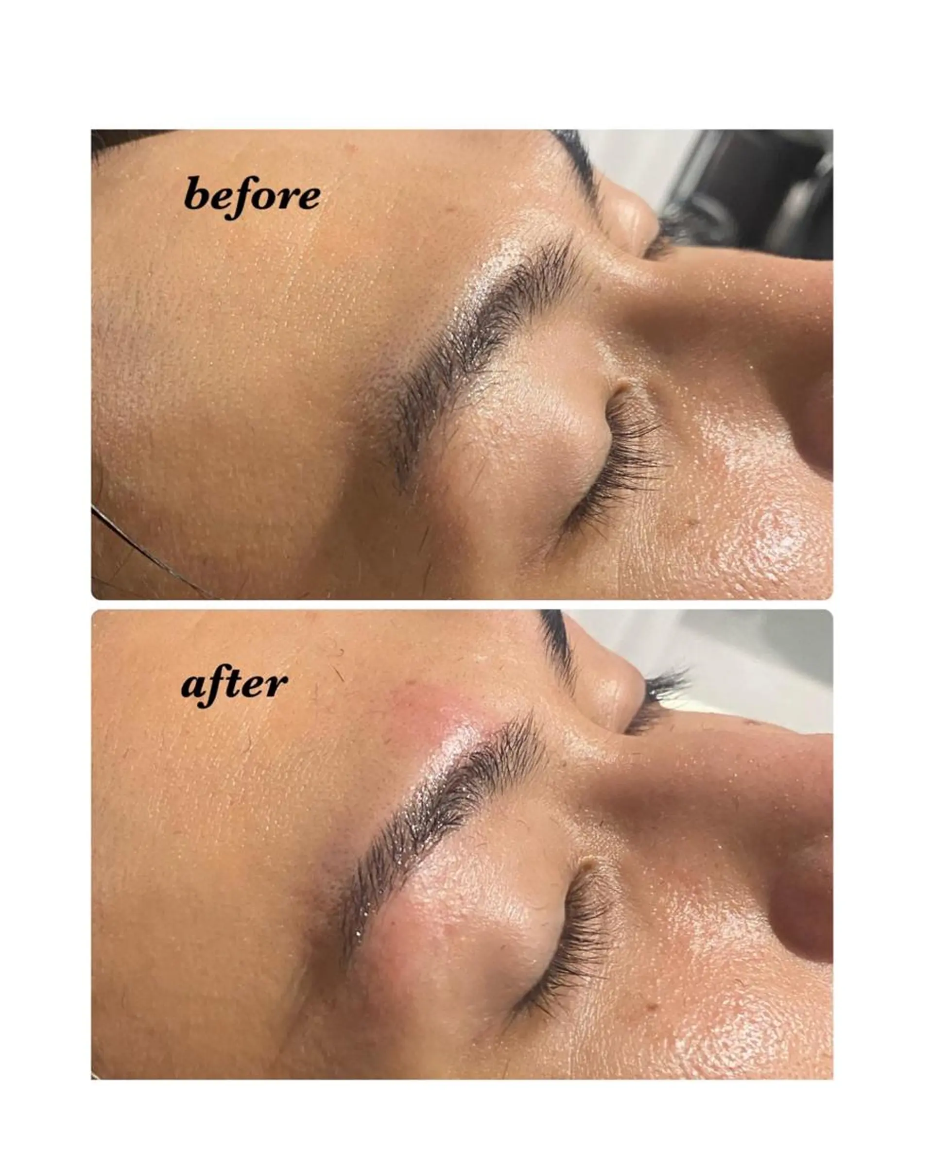 アイブロウ ハーブピーリング/韓国肌管理/フェイシャル/毛穴洗浄/眉毛/顔脱毛【糸脱毛専門】rev所属・ハーブピーリング🌹 毛穴洗浄❤️眉waxのエステ・リラクイメージ