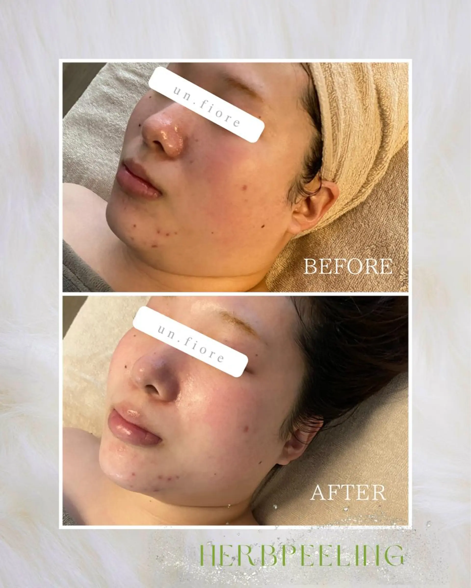 un Fiore🌷所属・小顔ハーブピーリング un.Fiore🌷のエステ・リラクイメージ