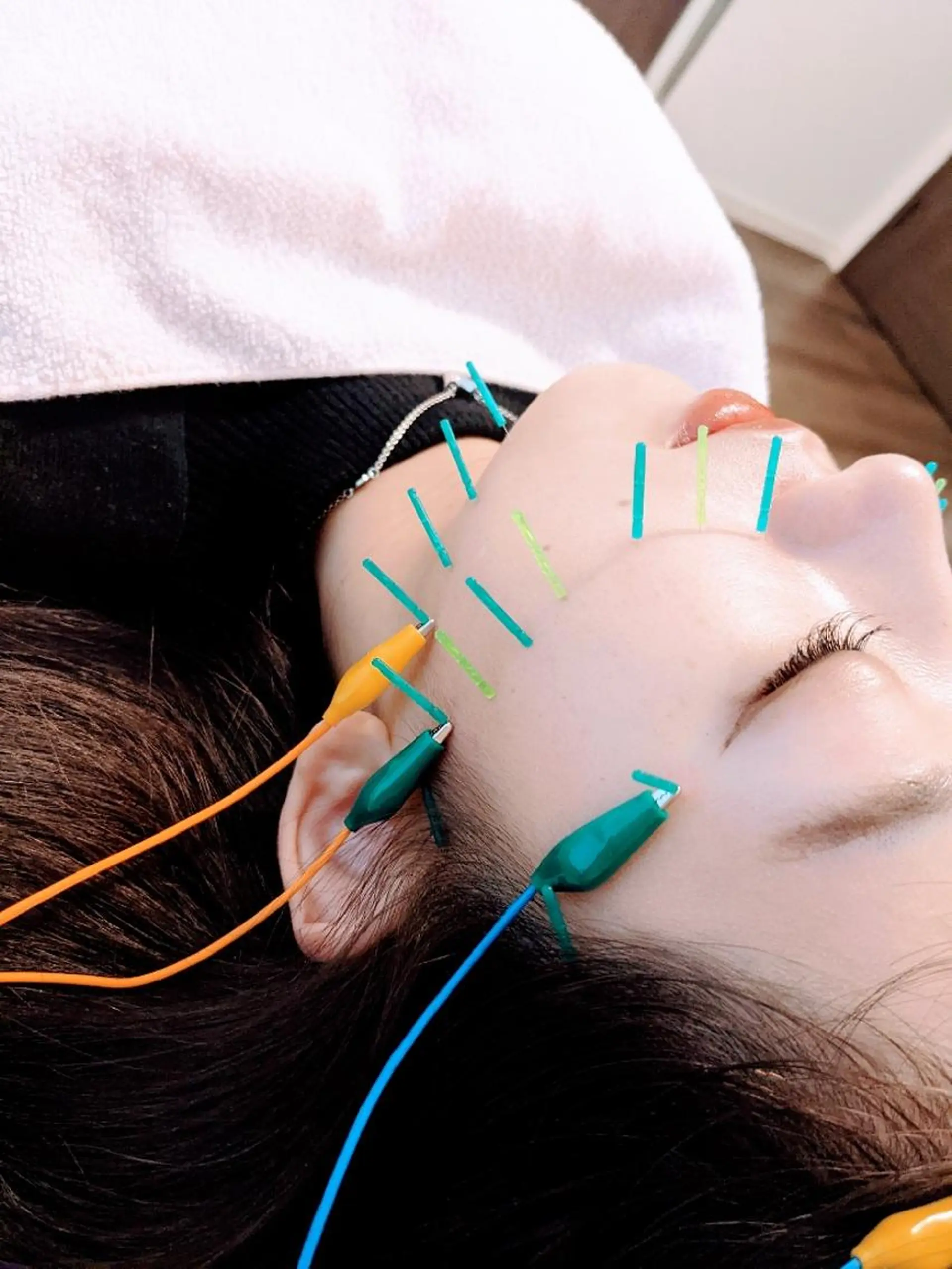 小顔美容鍼灸Acubelle Yakuin.【アキュベル薬院】所属・石川 真梨奈  美容鍼灸/アロマのエステ・リラクイメージ