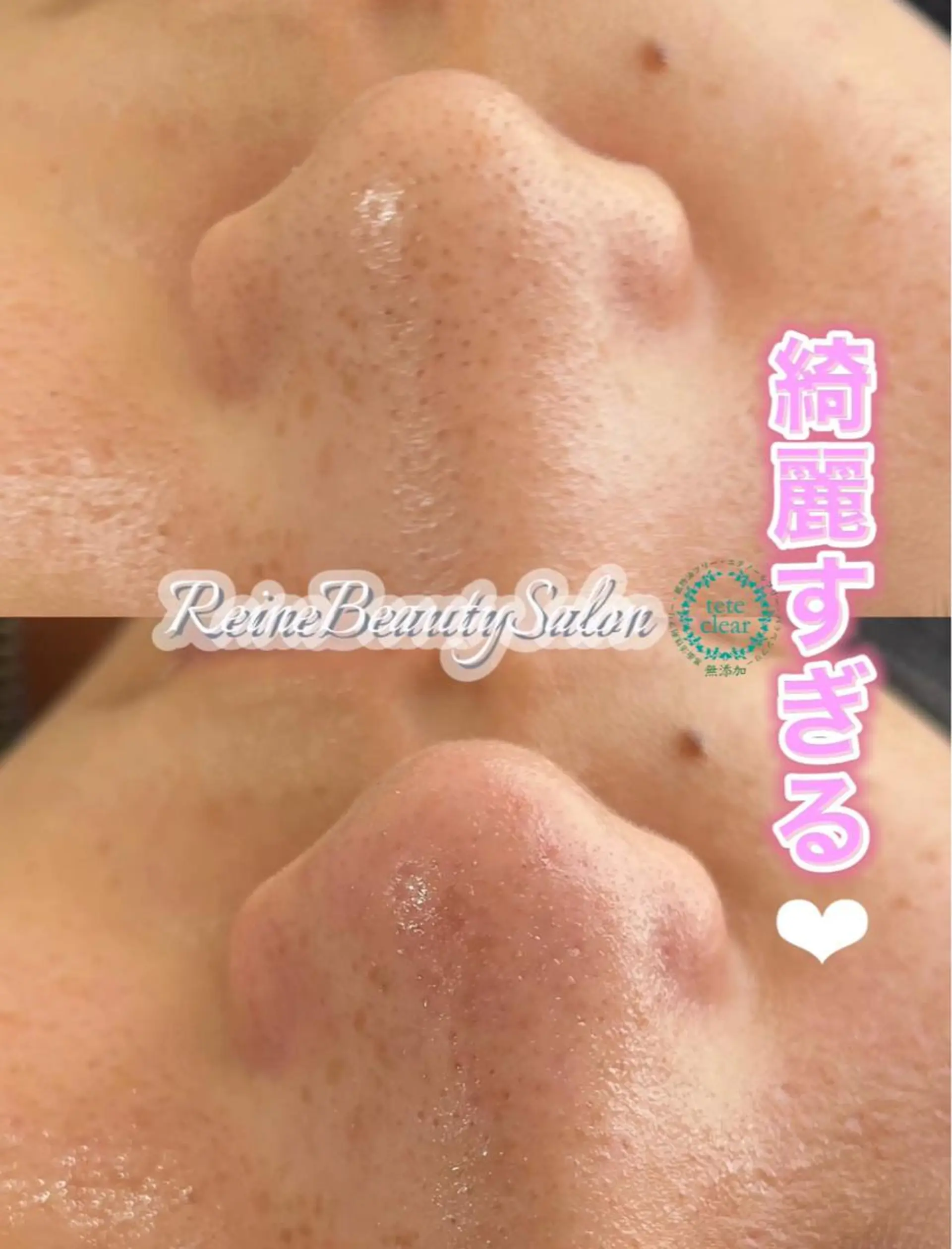 エステ Reine BeautySalon所属・毛穴/シミ肝斑/脱毛 横山梨里のエステ・リラクイメージ