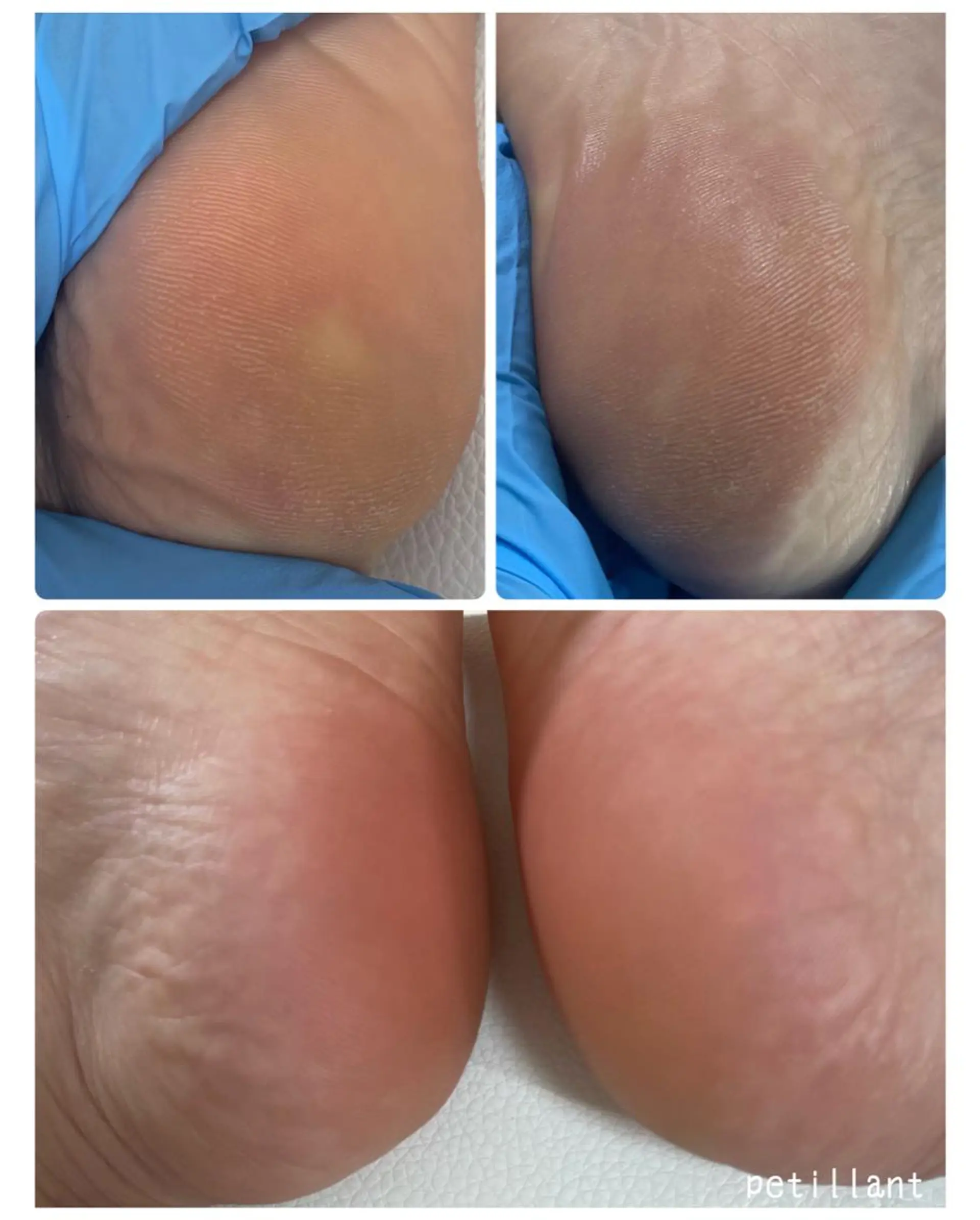 ネイル フットネイル 赤色 フットネイル petillant所属・nail salon petillantのネイルデザイン