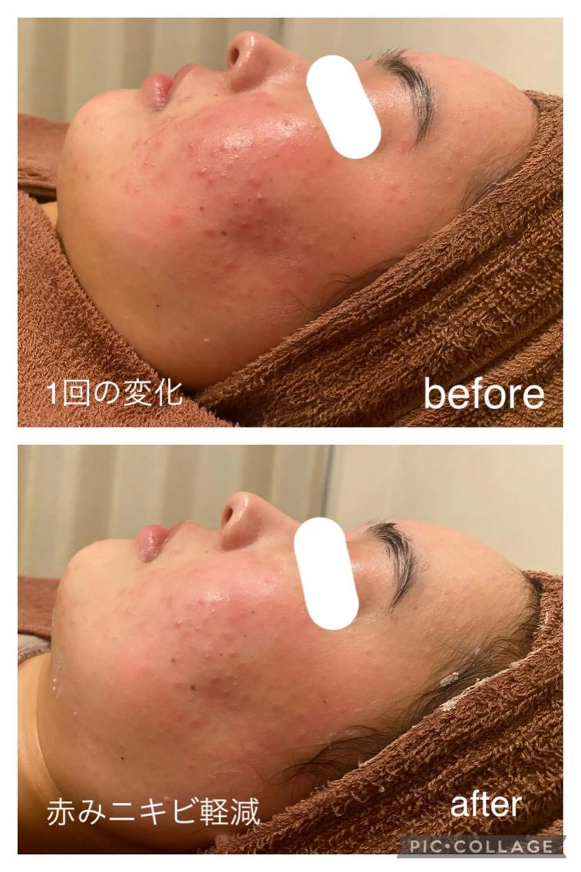 夏までに肌荒れ卒業 するサロン🌻のエステ・リラクイメージ