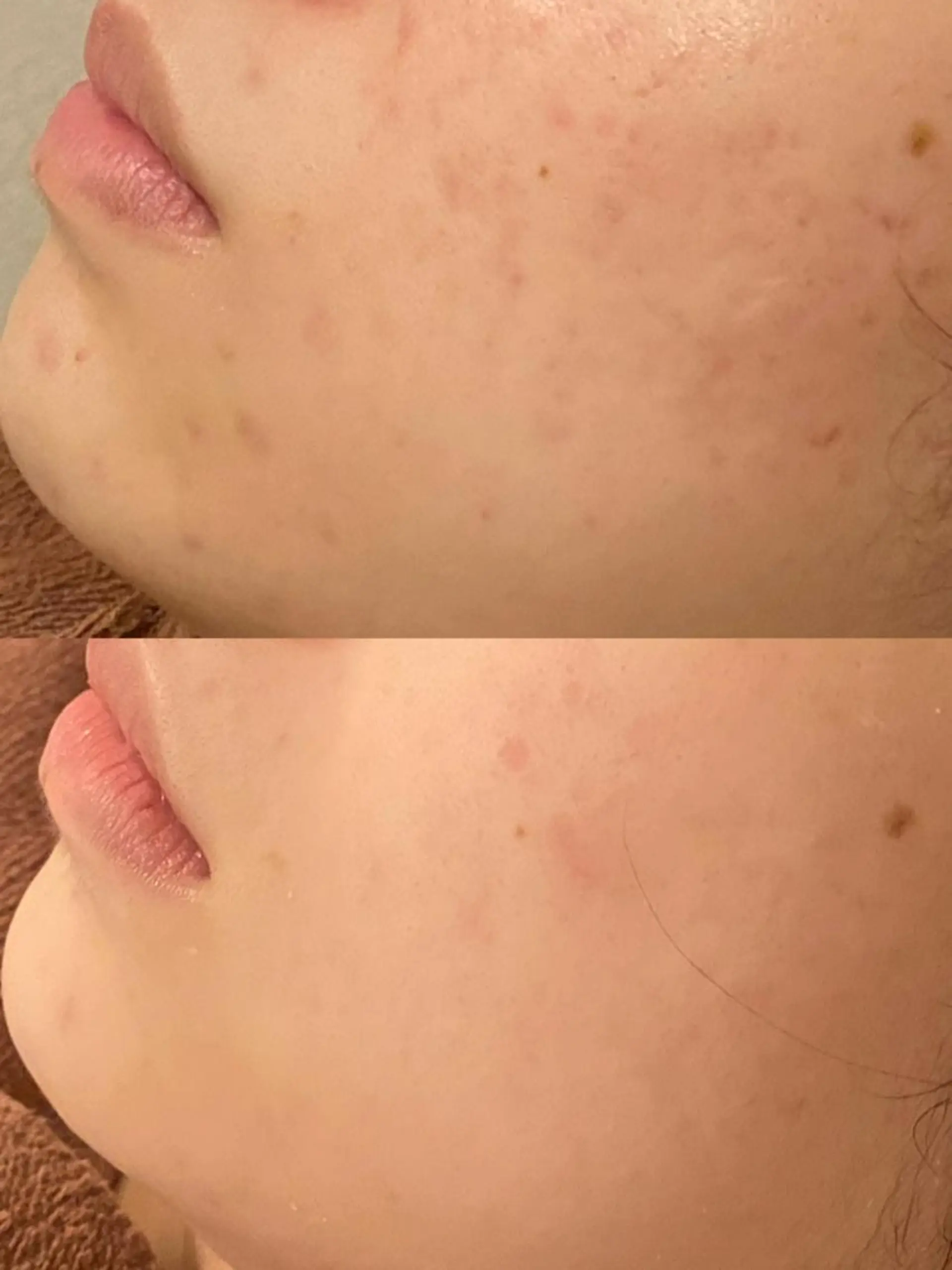 エステ リラク 都内で出来る肌管理！ 最短ニキビ改善のエステ・リラクイメージ