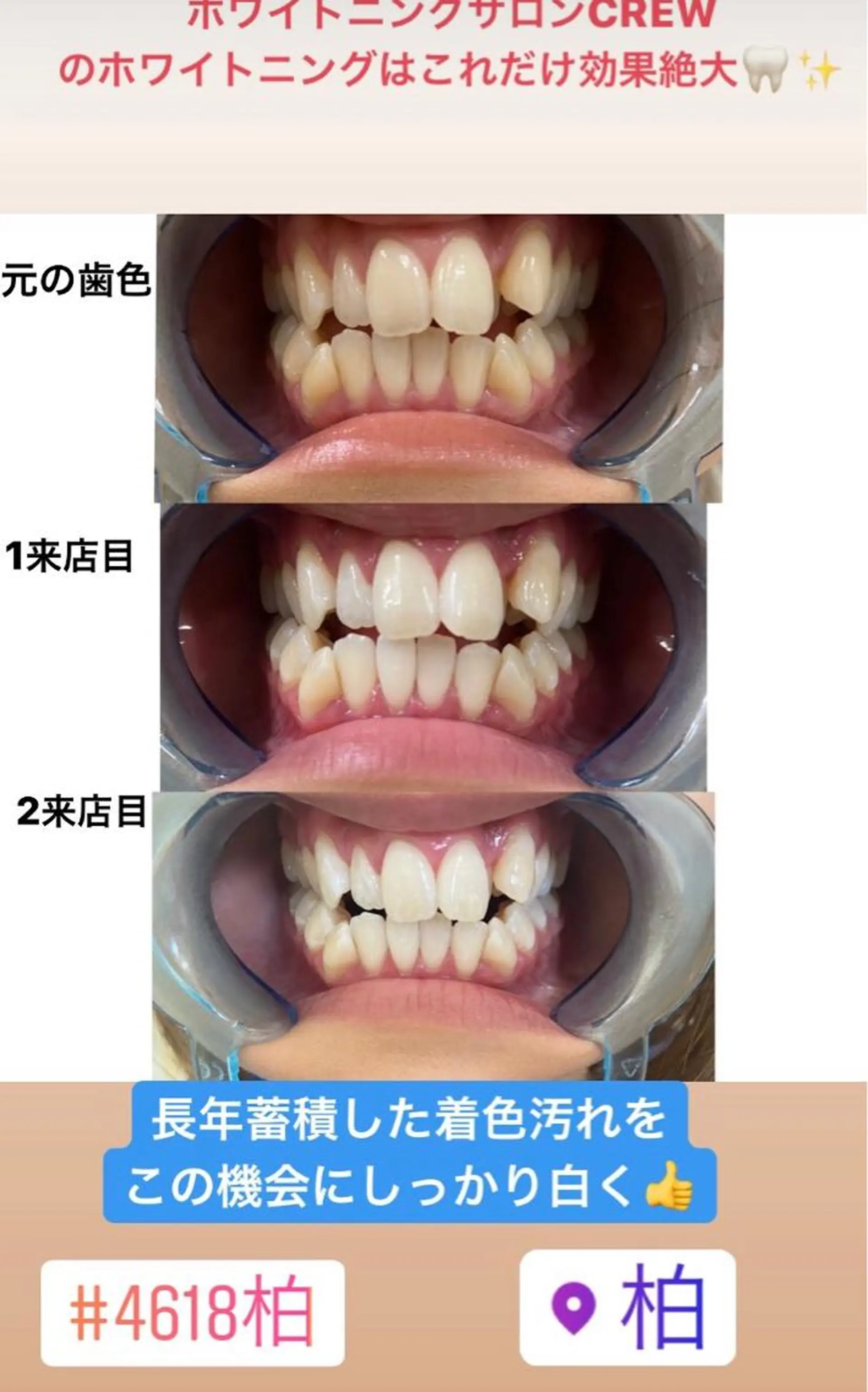 その他 ホワイトニング ⚓︎CREW柏⚓︎のその他イメージ