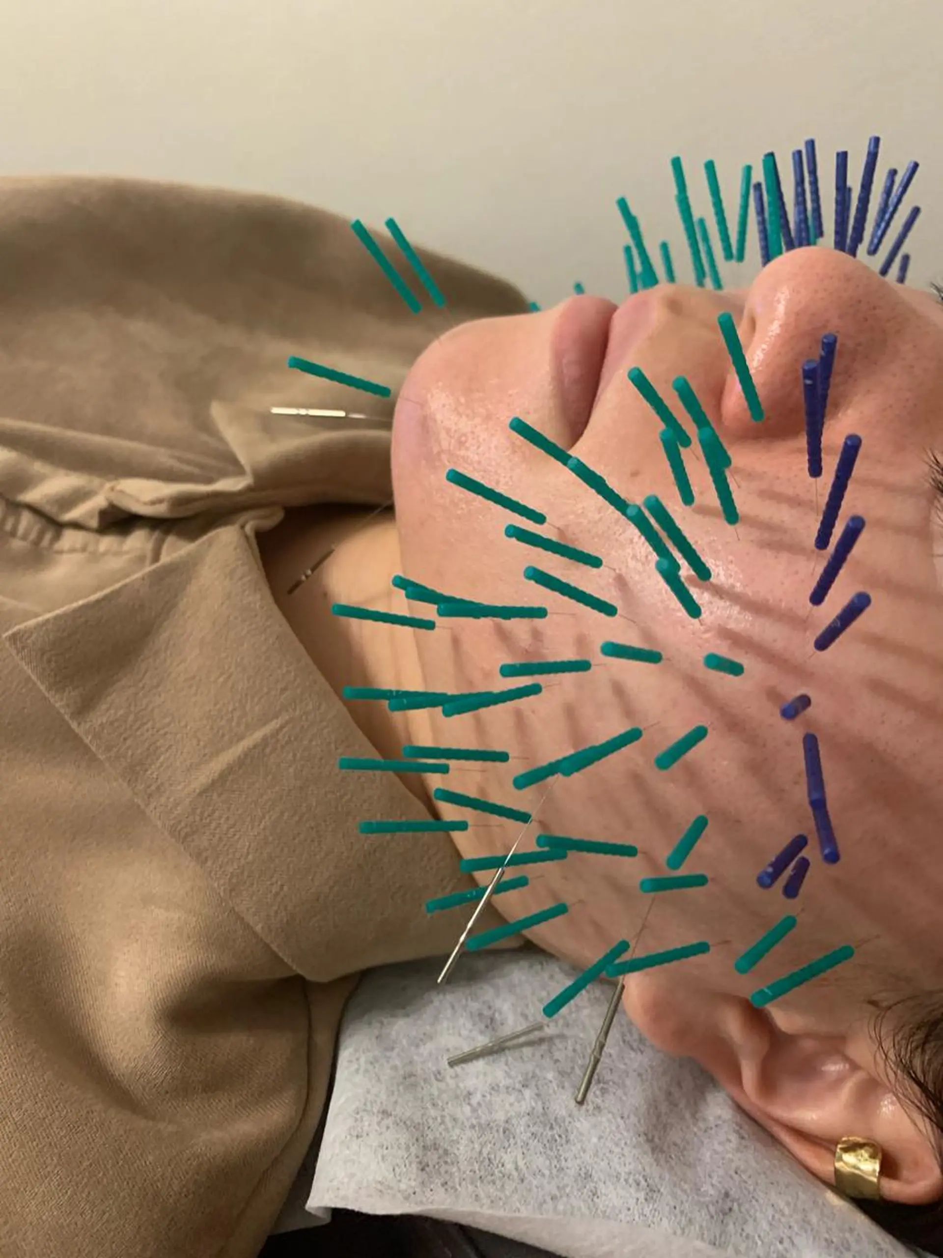 表参道鍼灸院K 美容鍼🔮ララピールのエステ・リラクイメージ