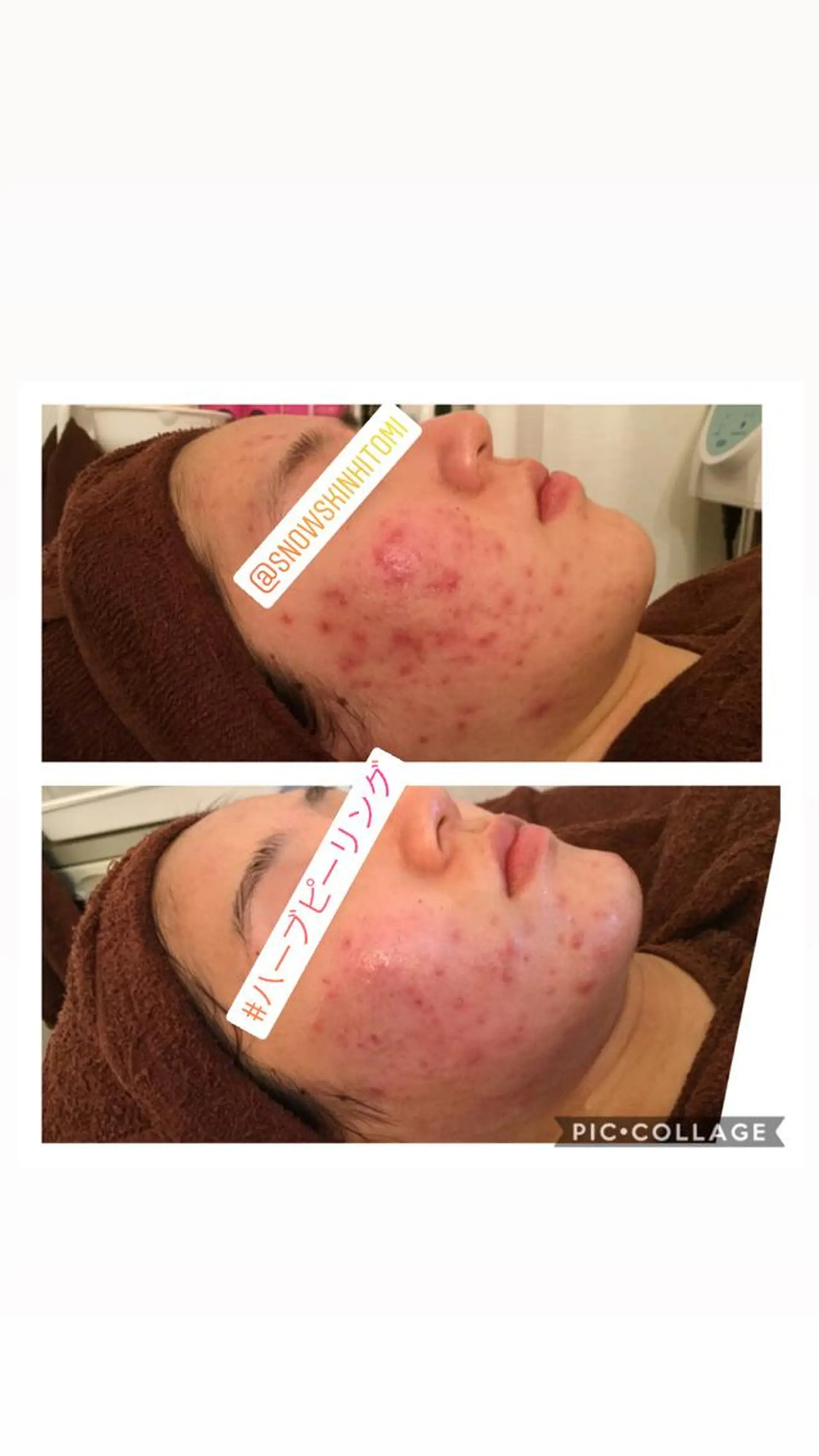 エステ リラク ニキビ/肌質改善専門 Snow skinのエステ・リラクイメージ