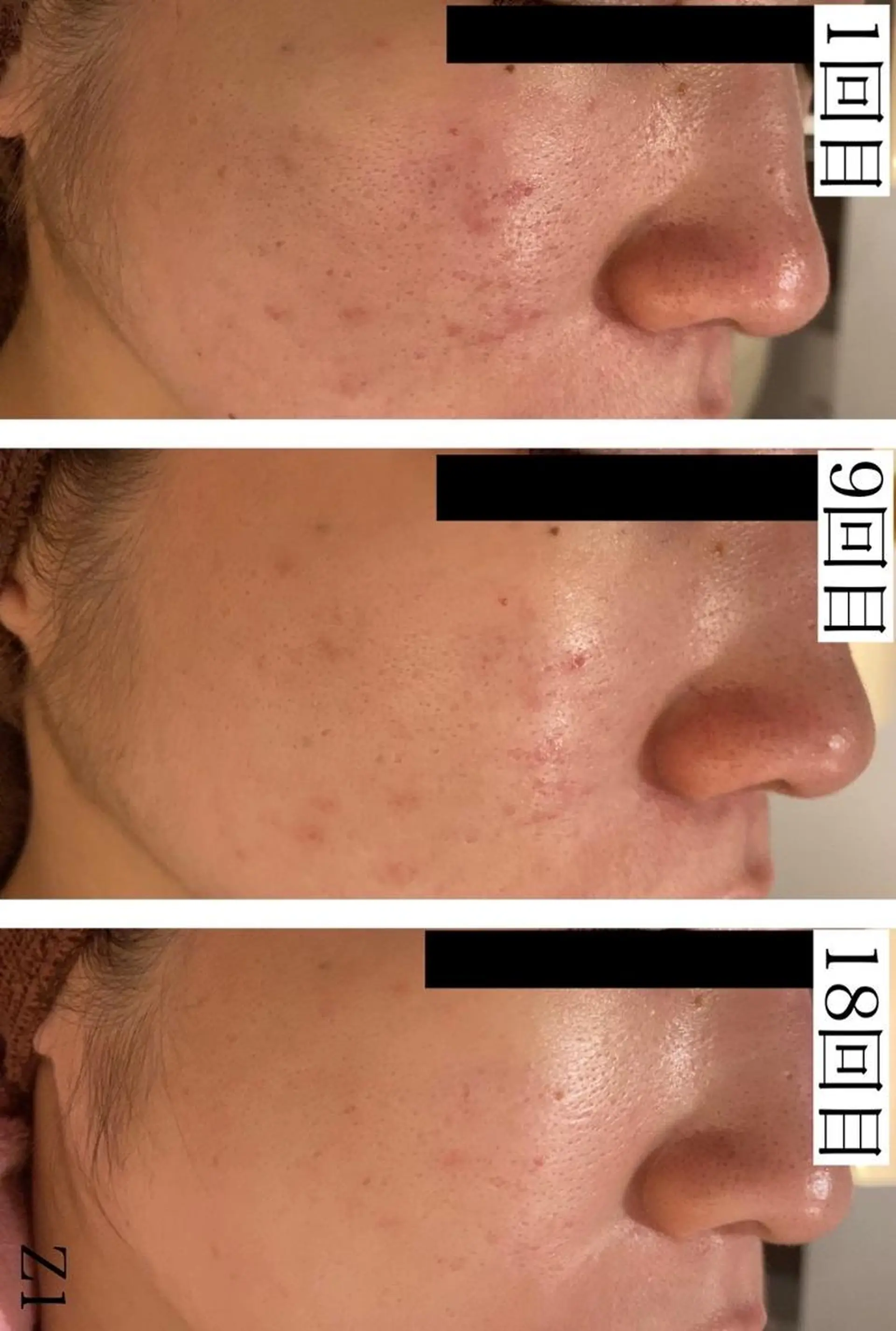 エステ リラク ニキビ跡改善専門🔥 医療にはできない改善のエステ・リラクイメージ