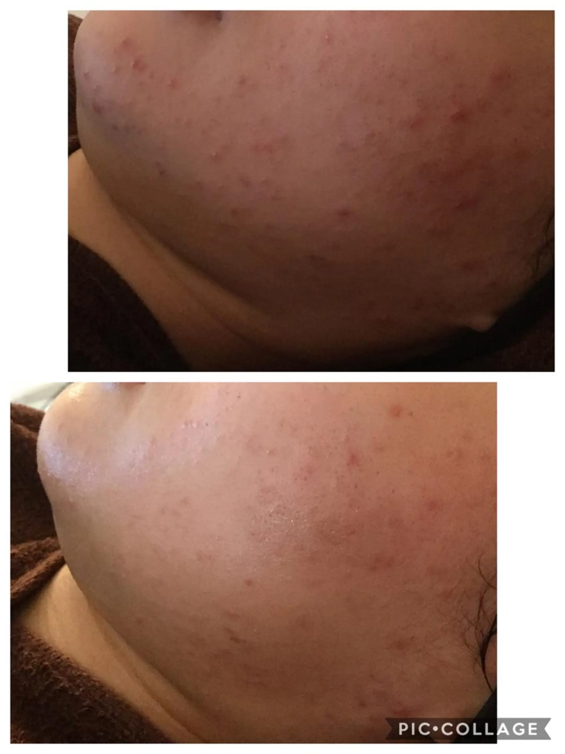 エステ リラク ニキビ/肌質改善専門 Snow skinのエステ・リラクイメージ