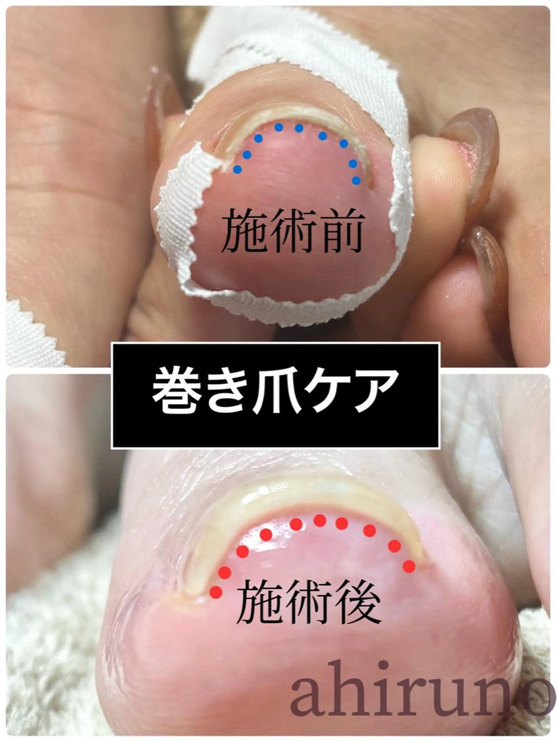 ネイル フットネイル ａｈｉｒｕｎｏ ✿ ｙｕiのネイルデザイン