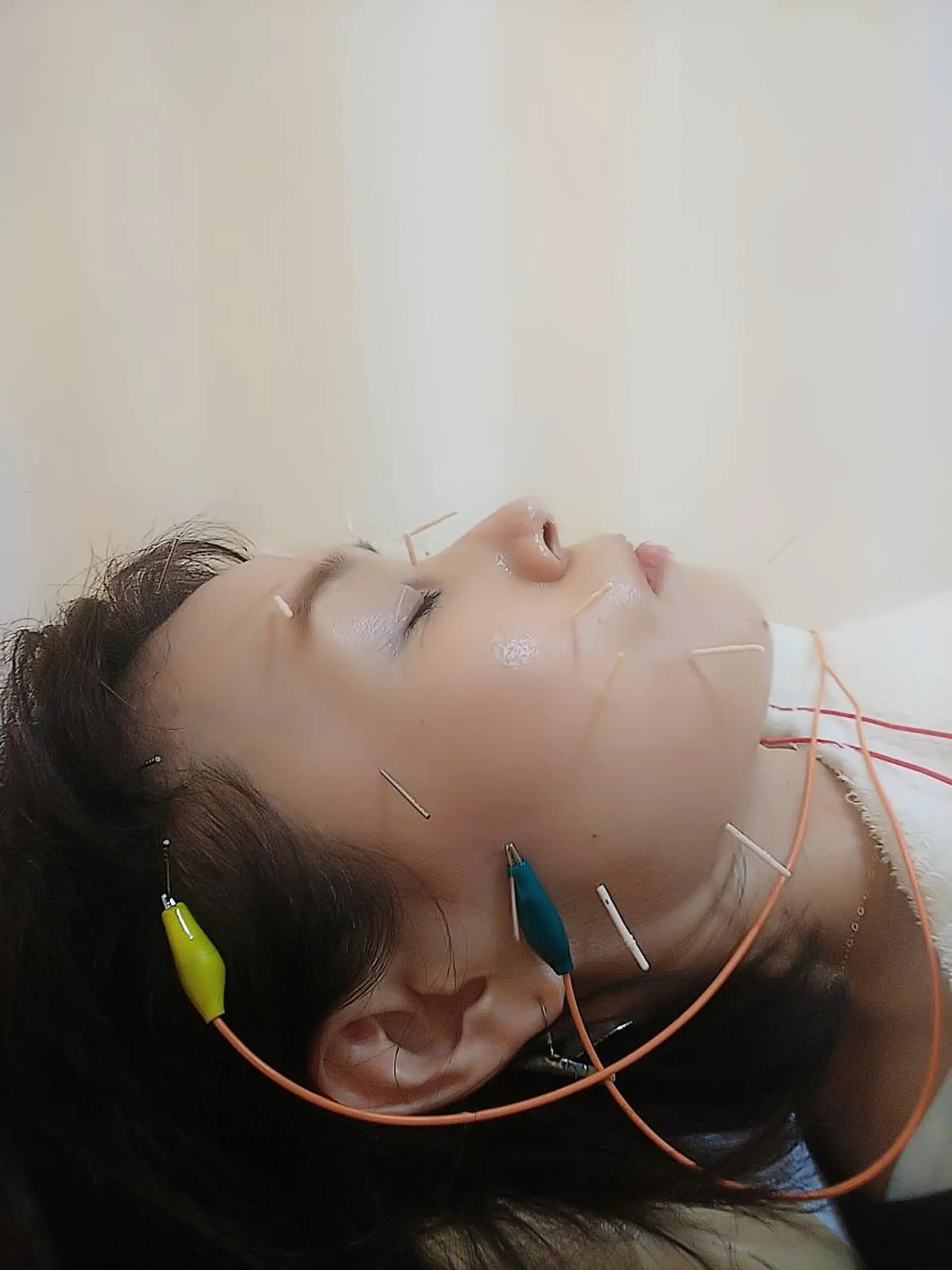 リフトアップ・たるみ ☆美容鍼小顔矯正のその他イメージ