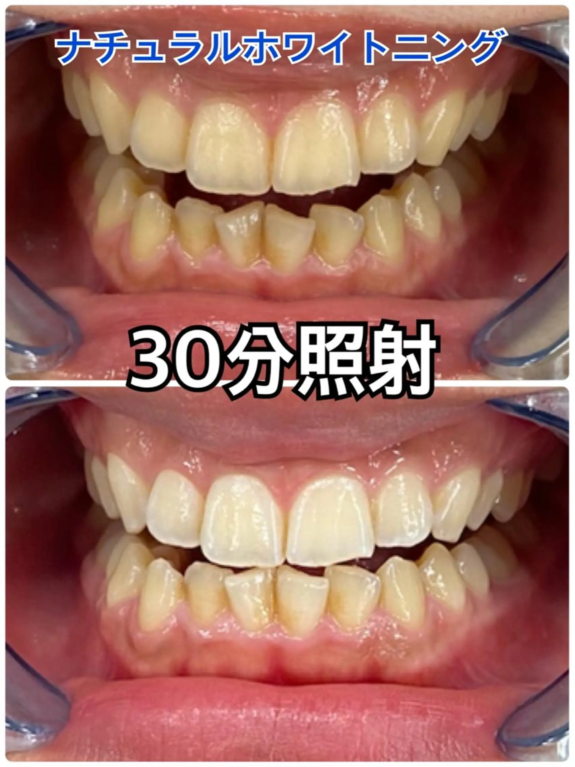 その他 Platinum Beauty 四条烏丸店所属・吉田亮利 ホワイトニング専門店のその他イメージ