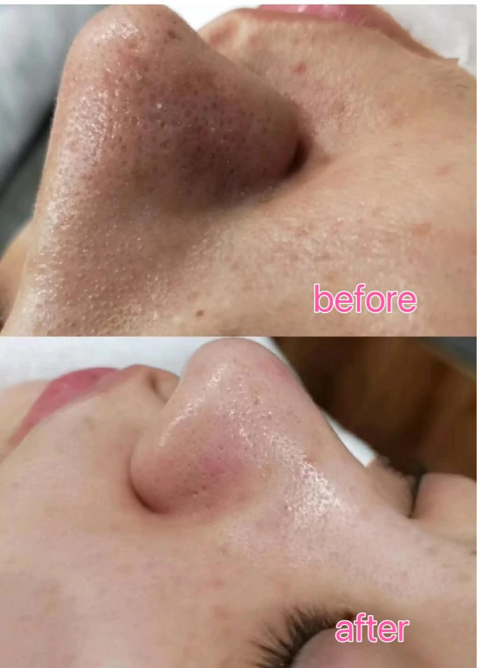 エステ リラク 毛穴洗浄& 睫毛パーマ上野御徒町のマツエク・マツパデザイン