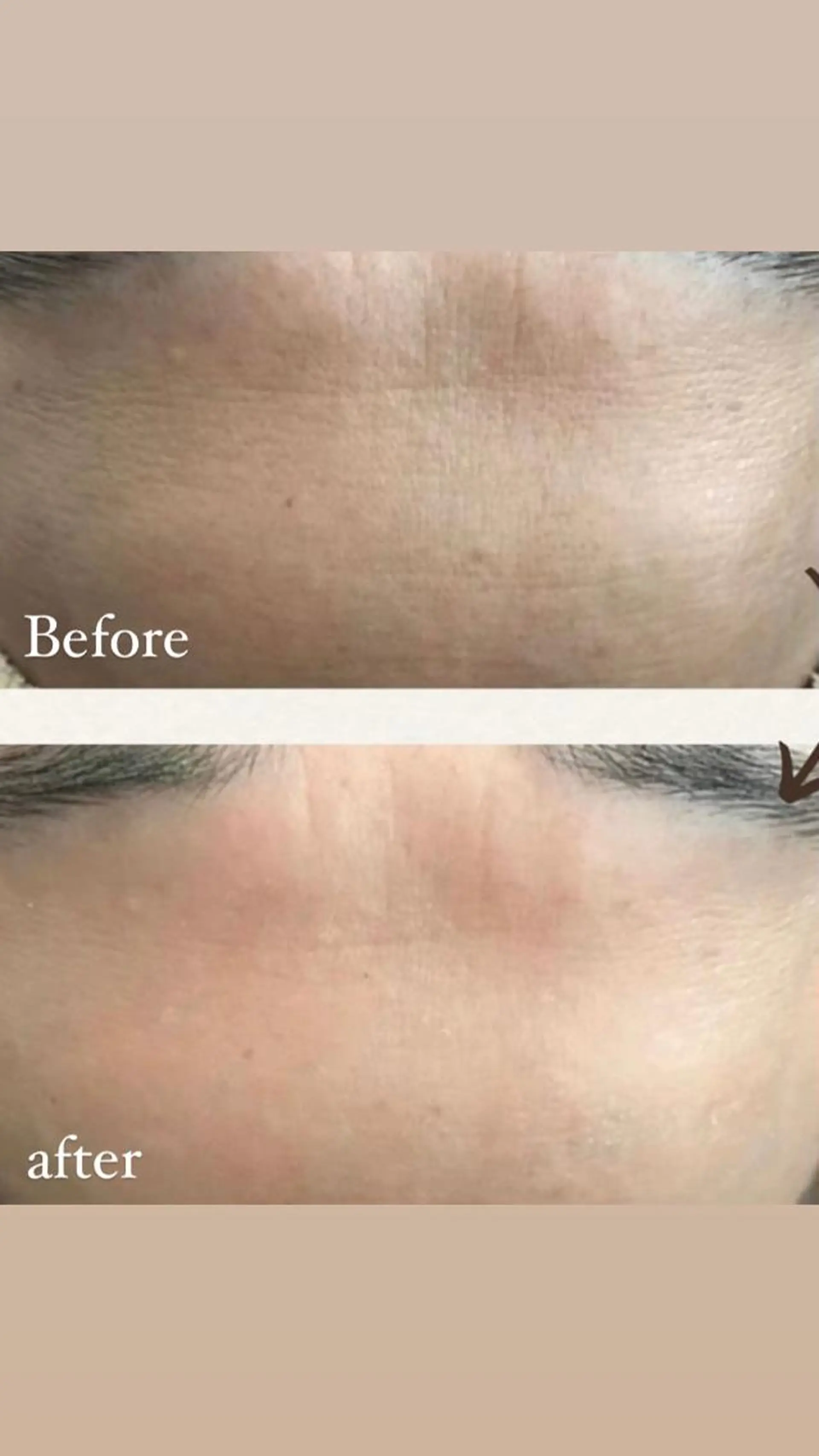 肌質改善ハーブピー リング🌿RINAのエステ・リラクイメージ