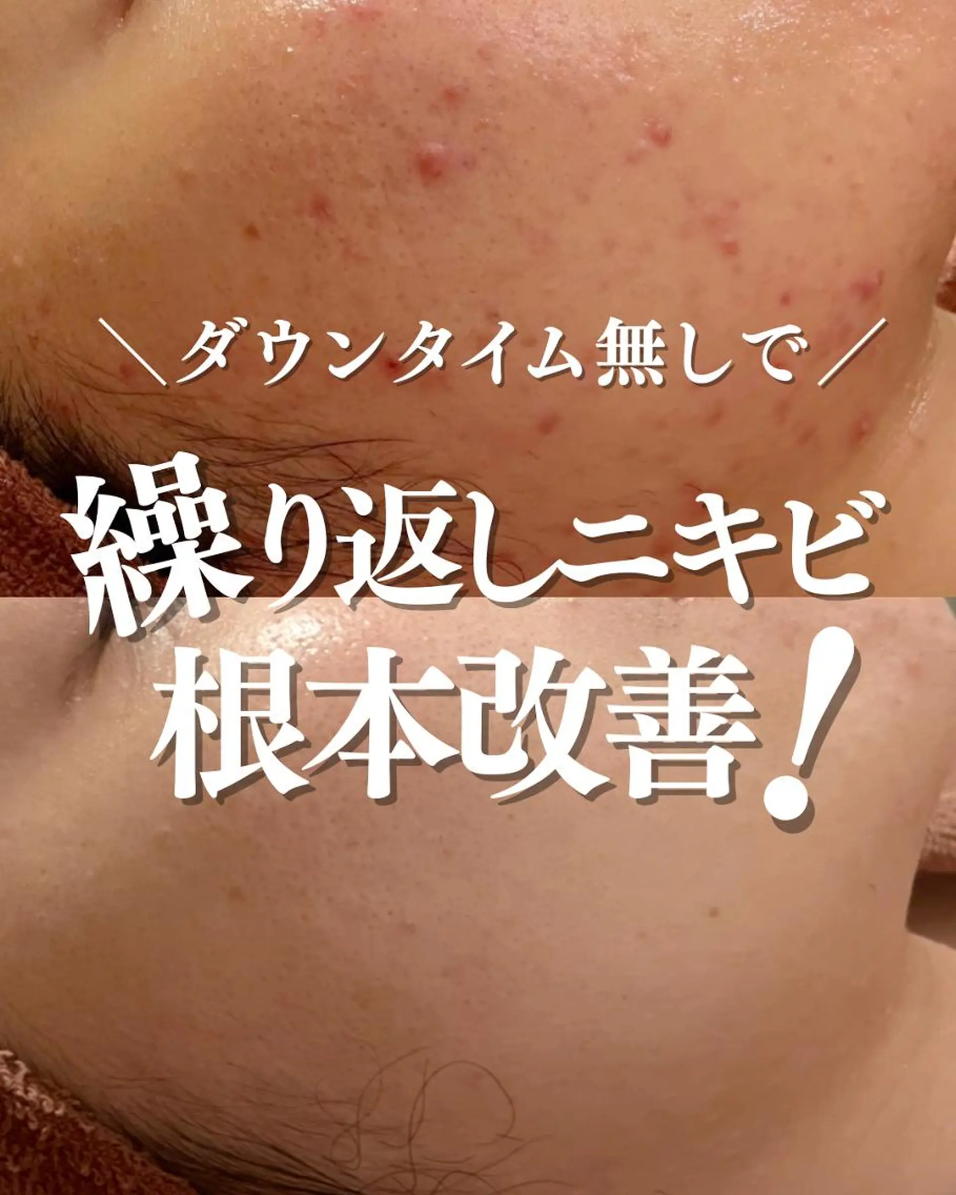 6万人の美肌実績🔥 最短ニキビ改善のエステ・リラクイメージ