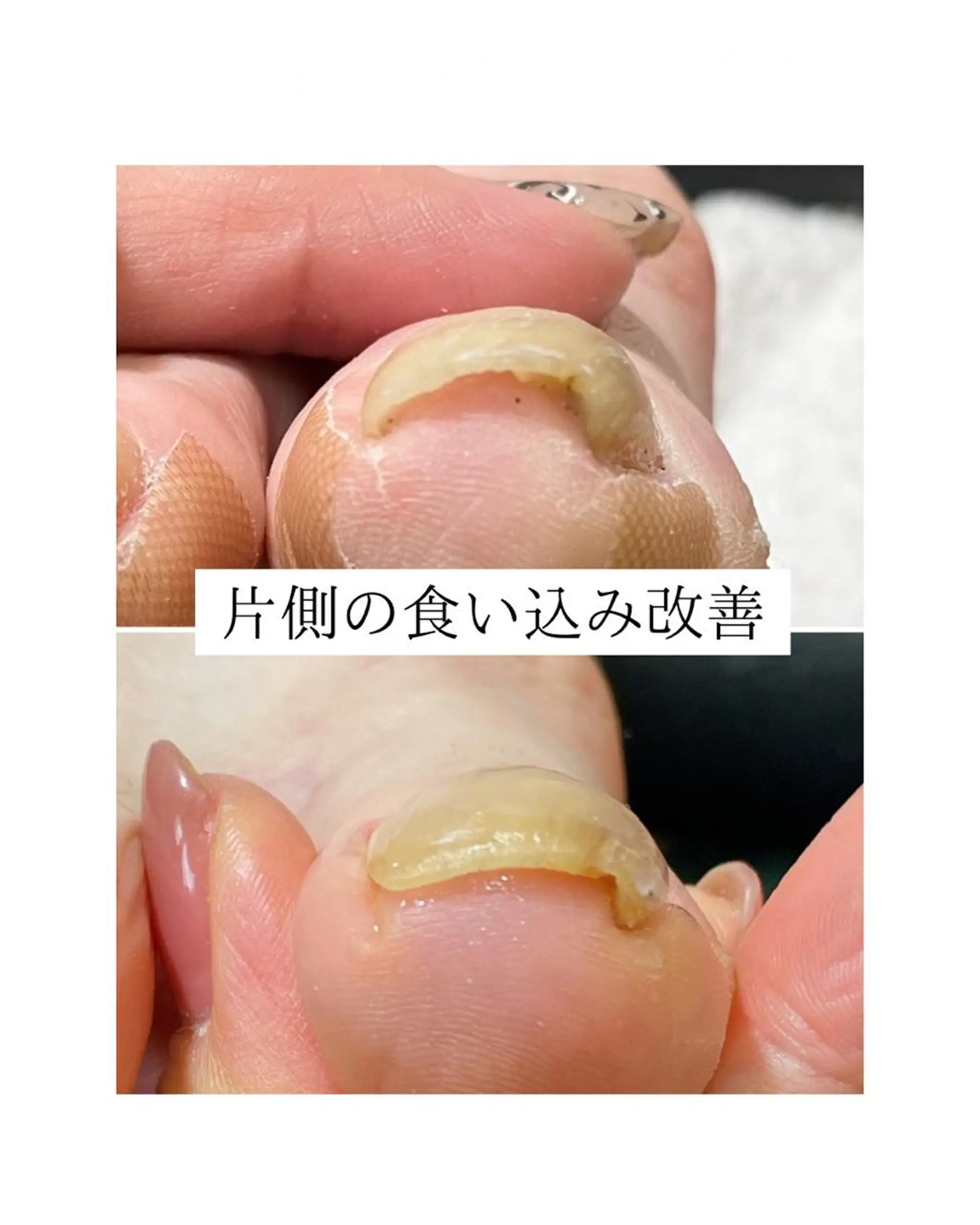 ネイル 黄色 深爪・巻き爪 専門サンセリテのネイルデザイン