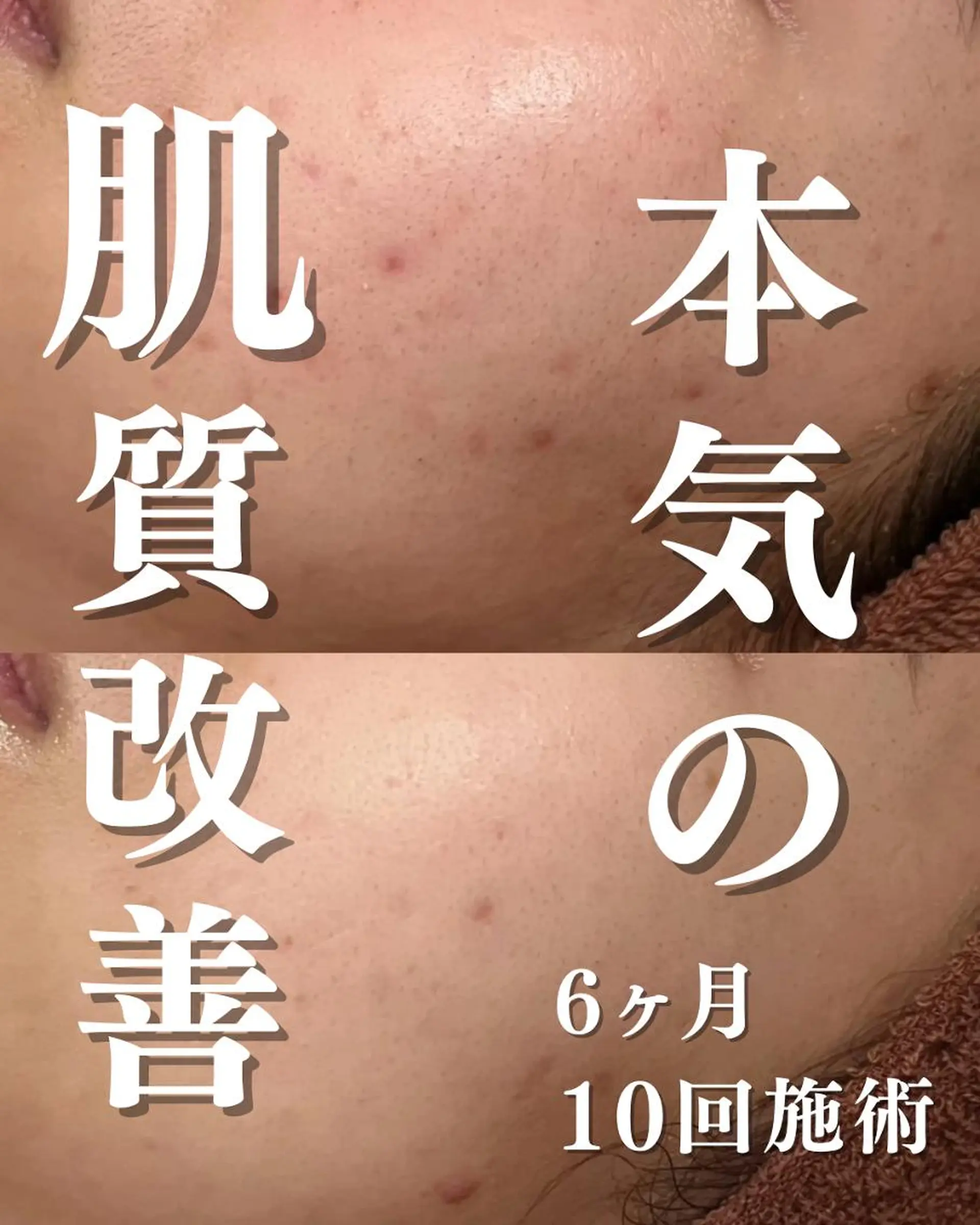 🔥3か月で肌革命 🔥ニキビ専門店のエステ・リラクイメージ