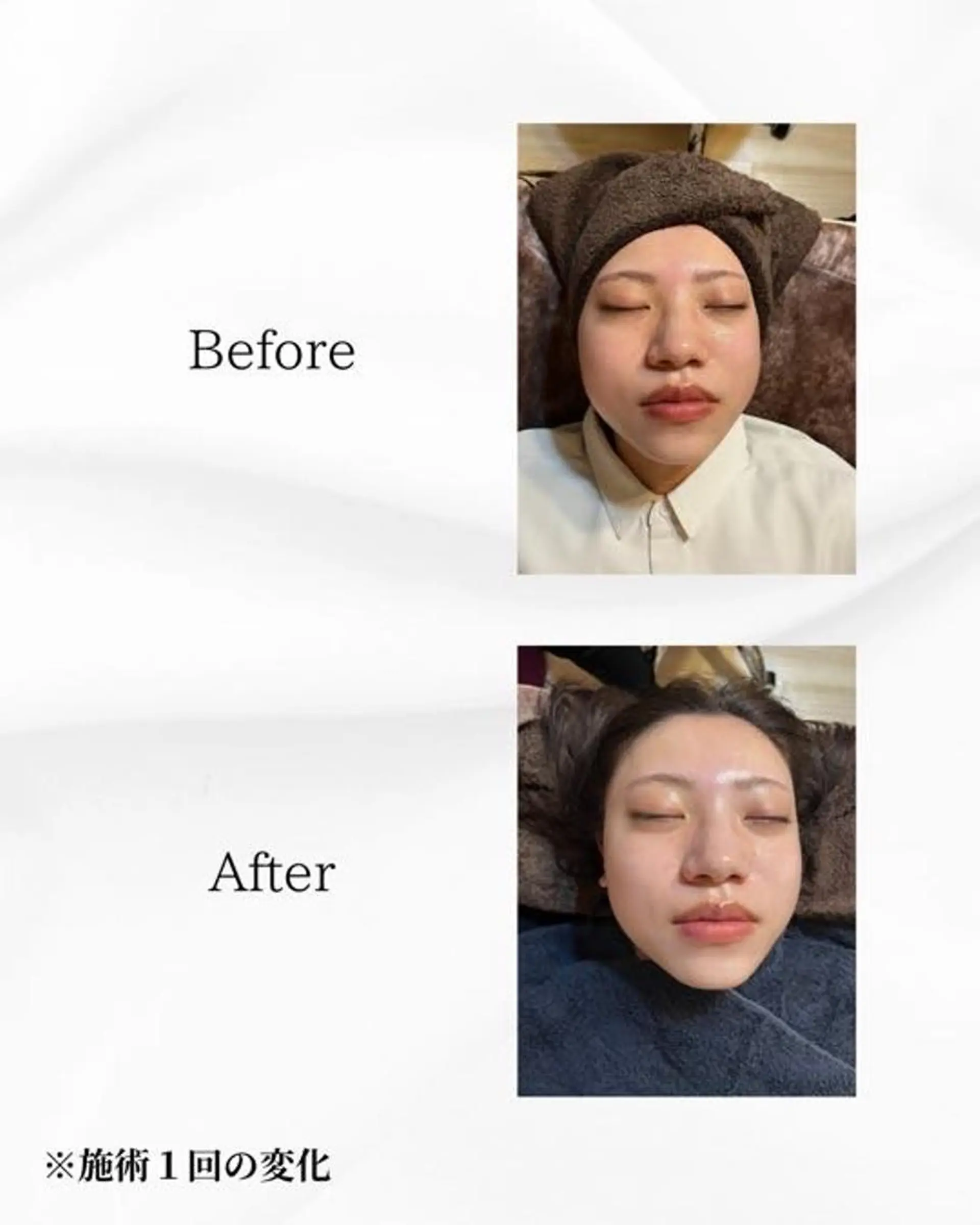 エステ ハーブピーリング🌿 REVI/Ayanoのエステ・リラクイメージ