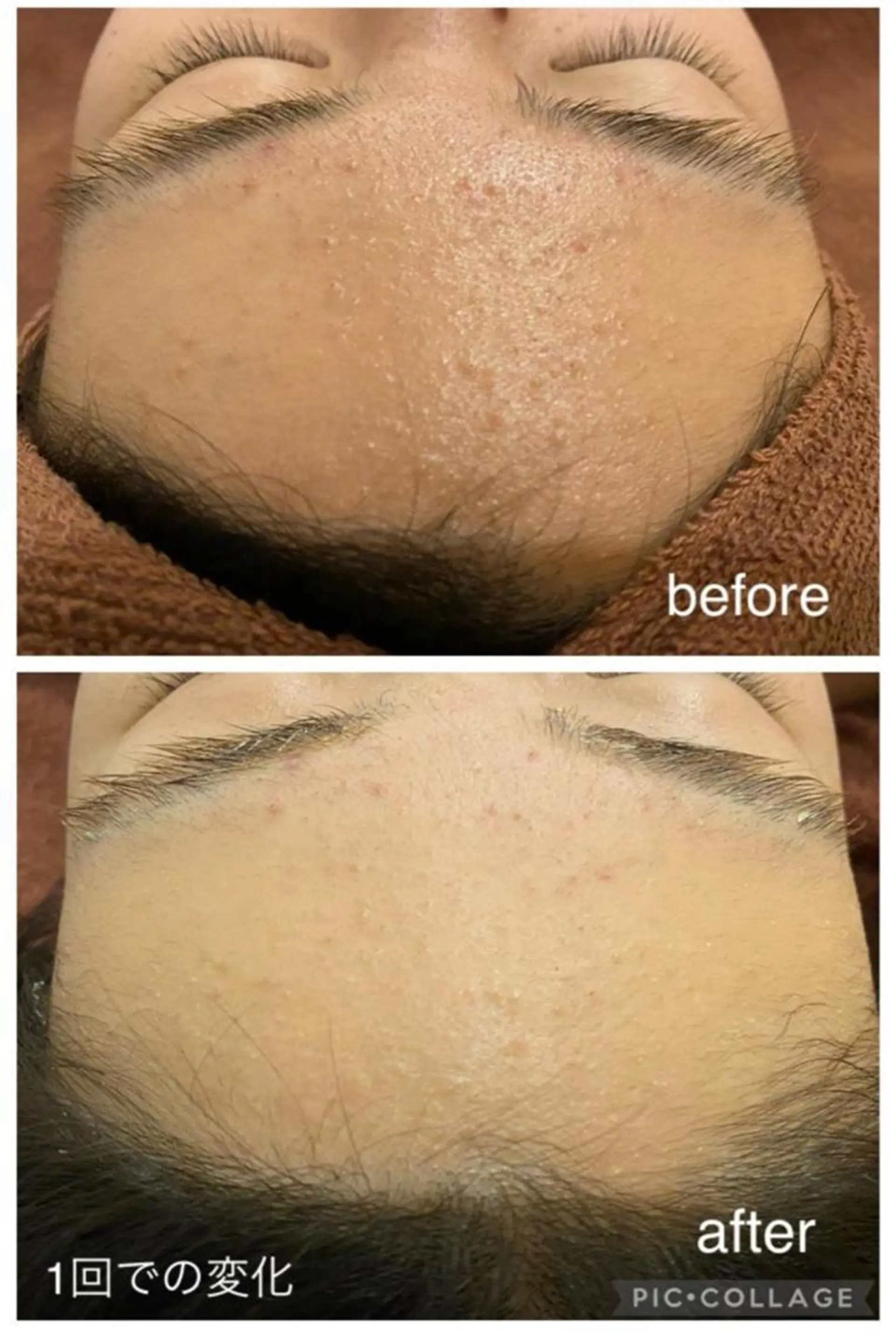 🔥3か月で肌革命 🔥ニキビ専門店のエステ・リラクイメージ