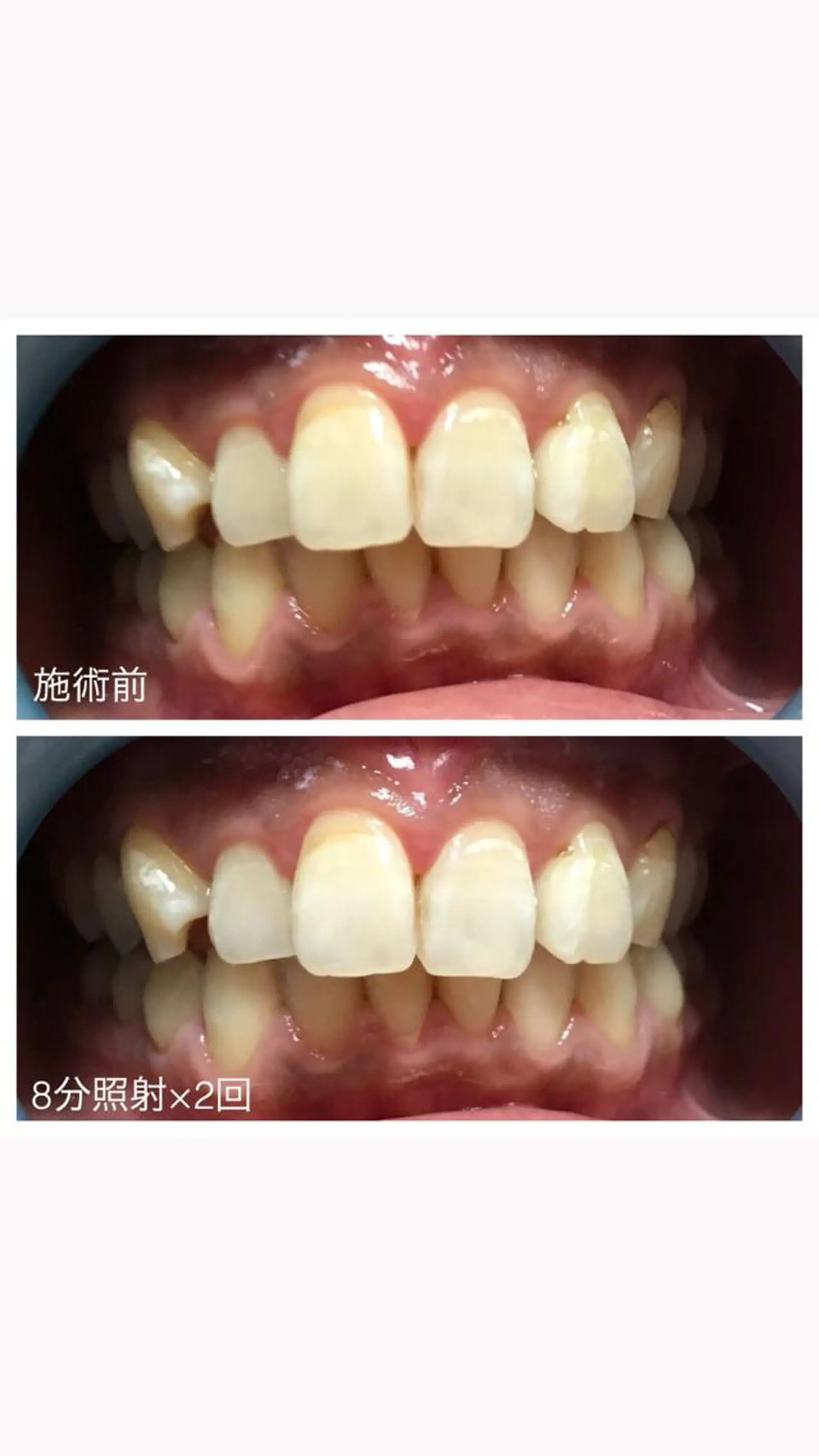 ネイル/耳つぼ /新ホワイトニングのネイルデザイン