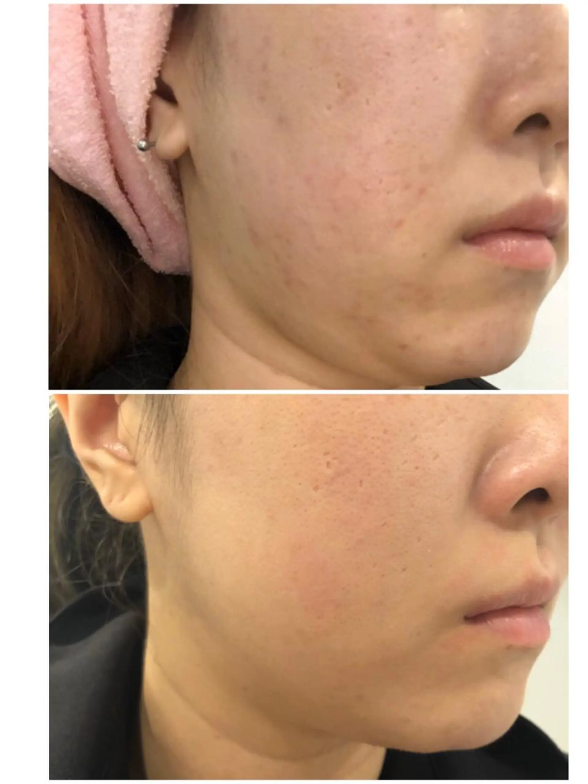 エステ 【リベルハーブピーリング認定店】敏感肌・美白脱毛専門店Dione立川店所属・Dione 立川店のエステ・リラクイメージ