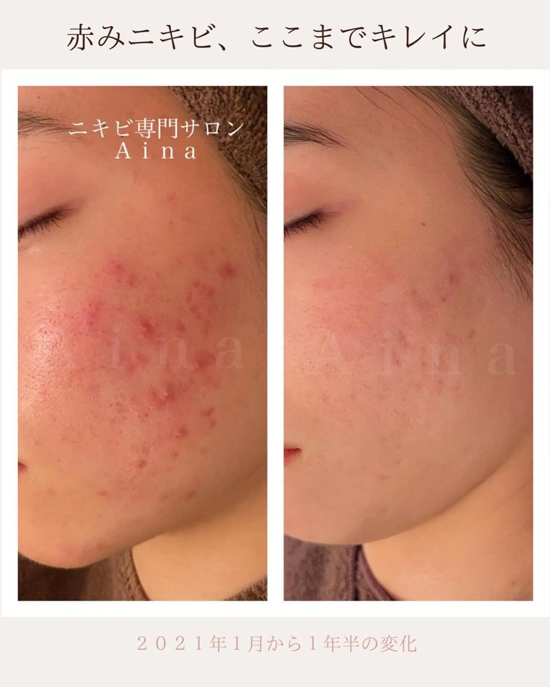 セミロング エステ リラク ニキビ跡専門サロン Ainaのエステ・リラクイメージ