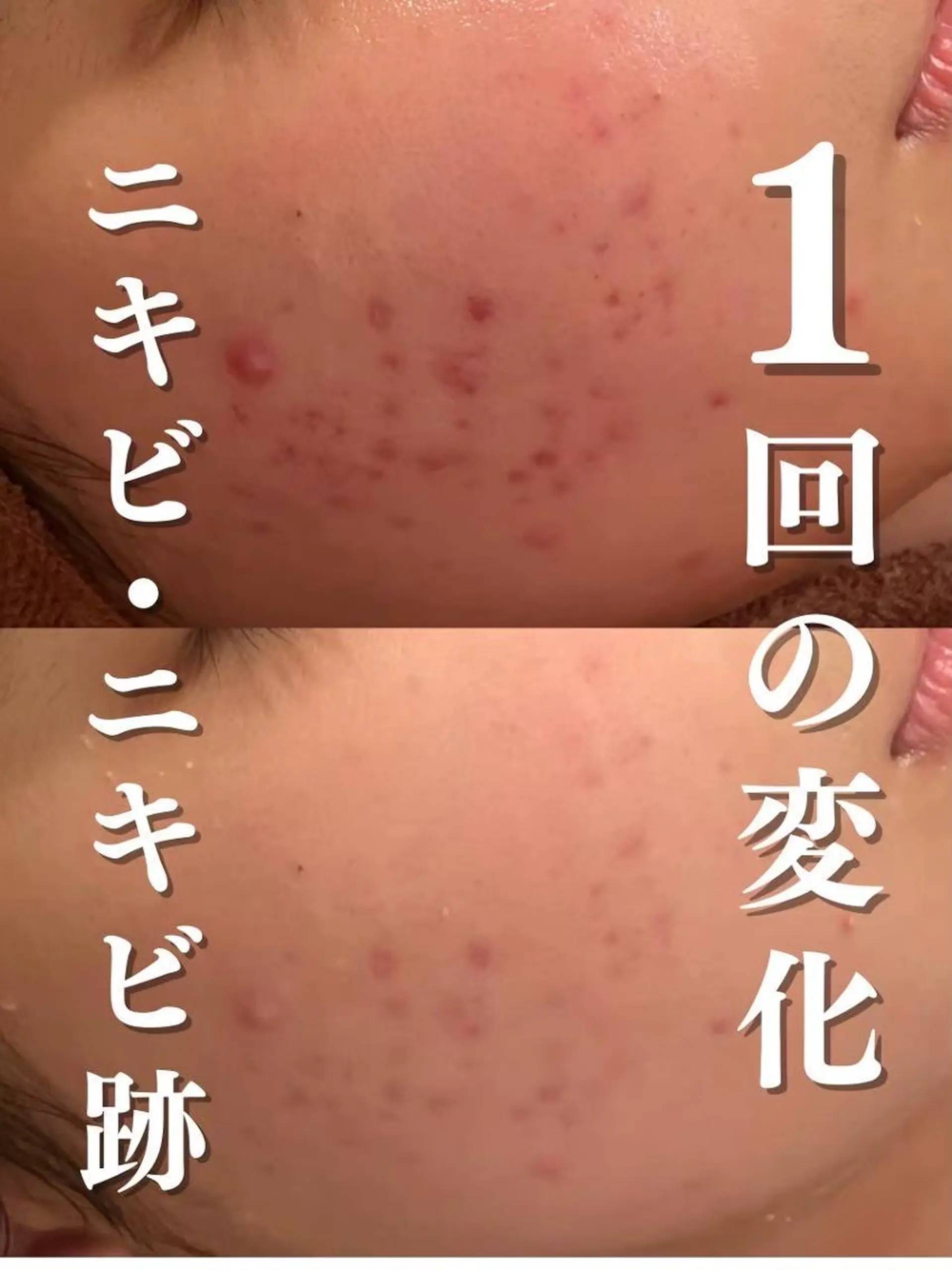 ニキビ特化型エステ 🍓最短で肌質改善のエステ・リラクイメージ