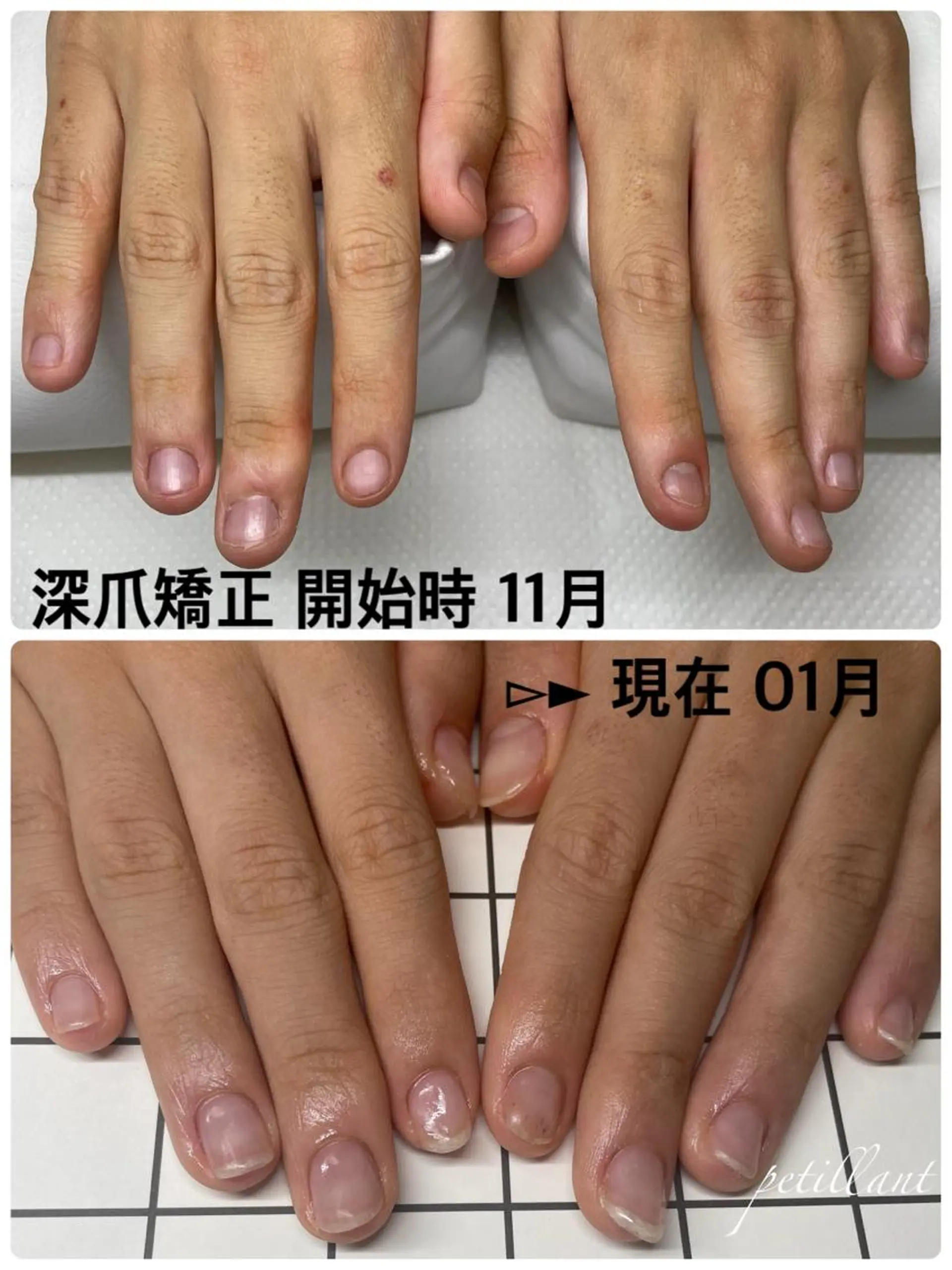 ネイル クリアネイル 長さ出し ジェルネイル ピンク petillant所属・nail salon petillantのネイルデザイン