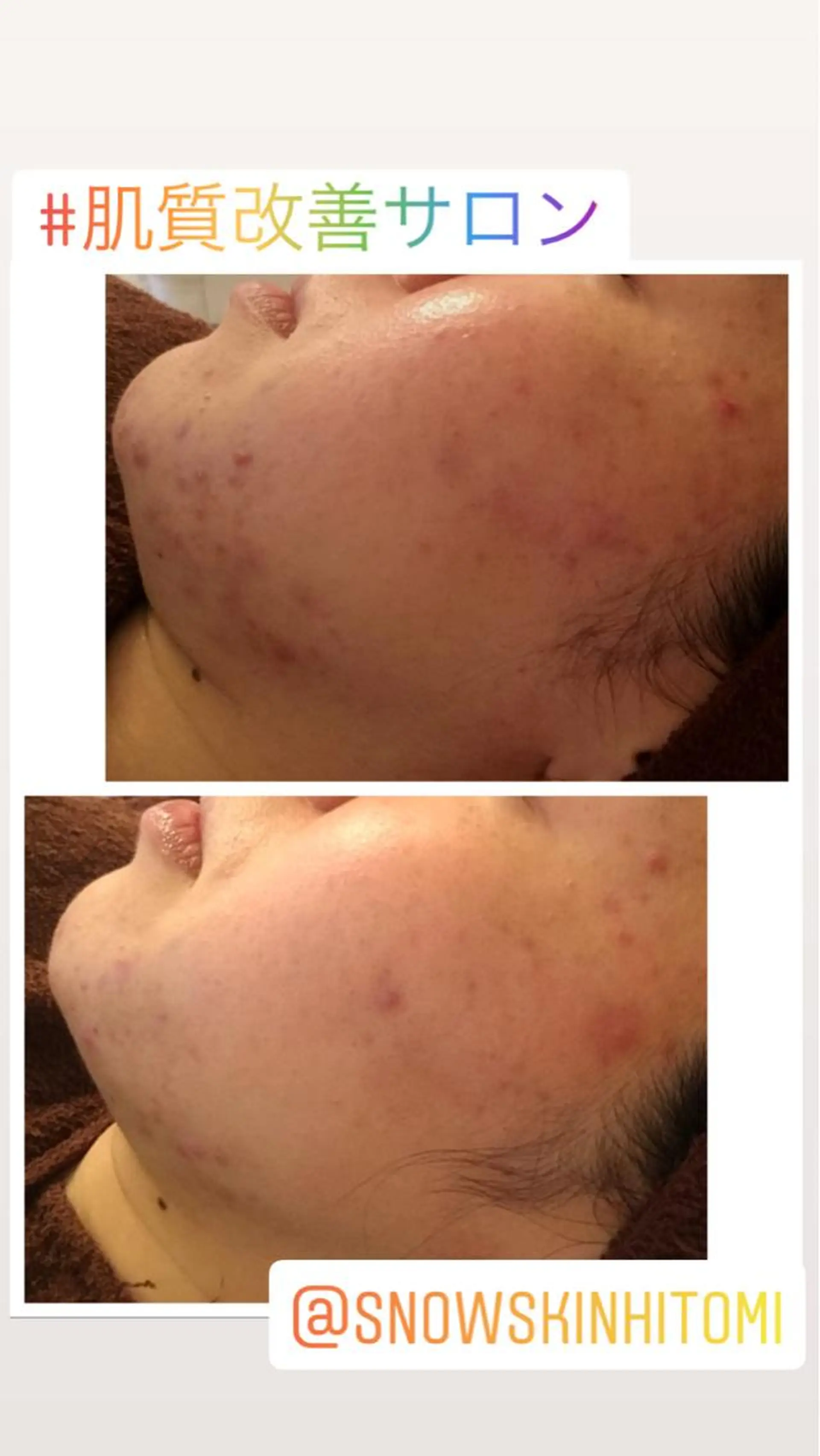 エステ リラク ニキビ/肌質改善専門 Snow skinのエステ・リラクイメージ