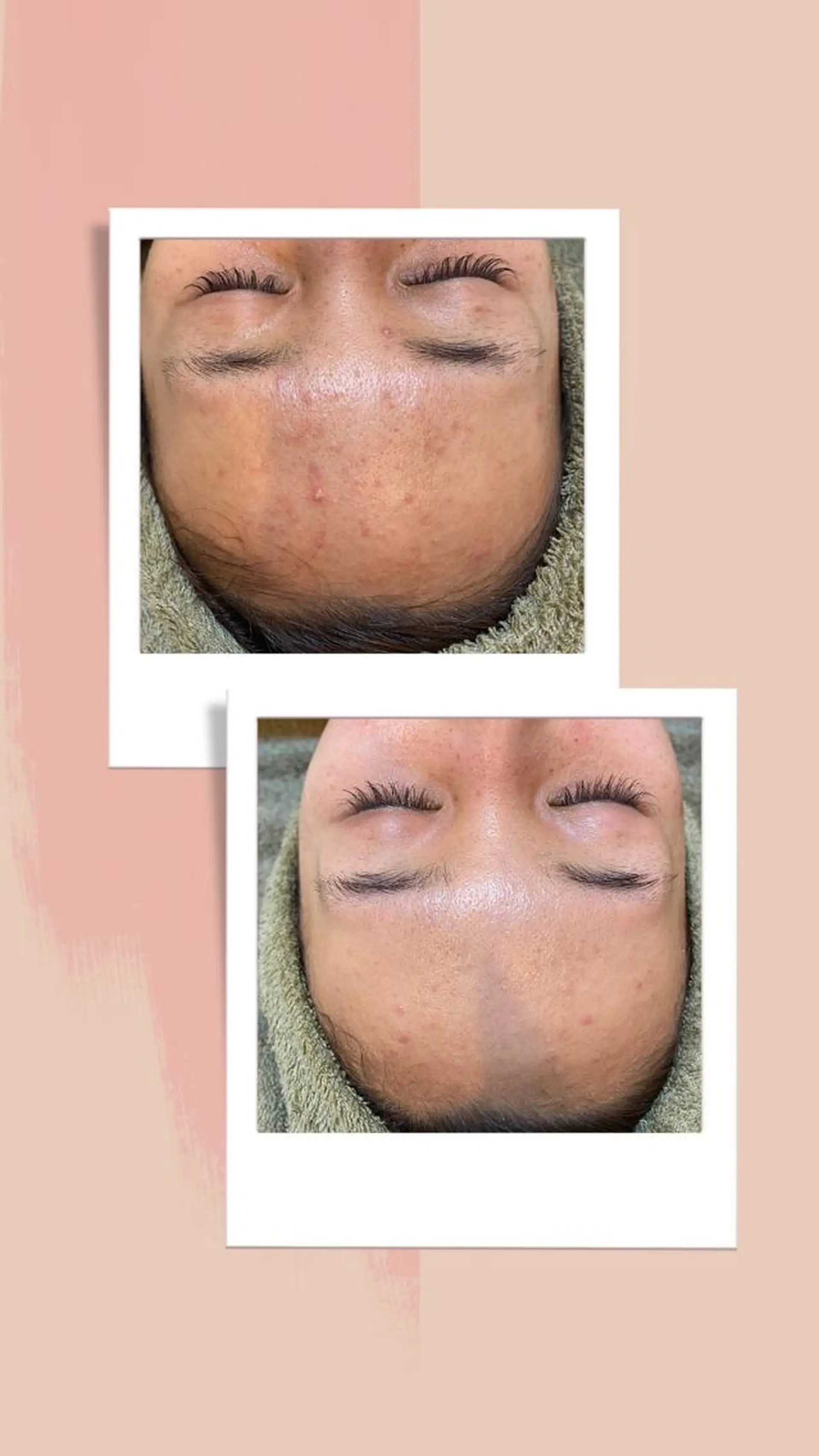 脱毛｜ピーリング ROOM.Sのエステ・リラクイメージ