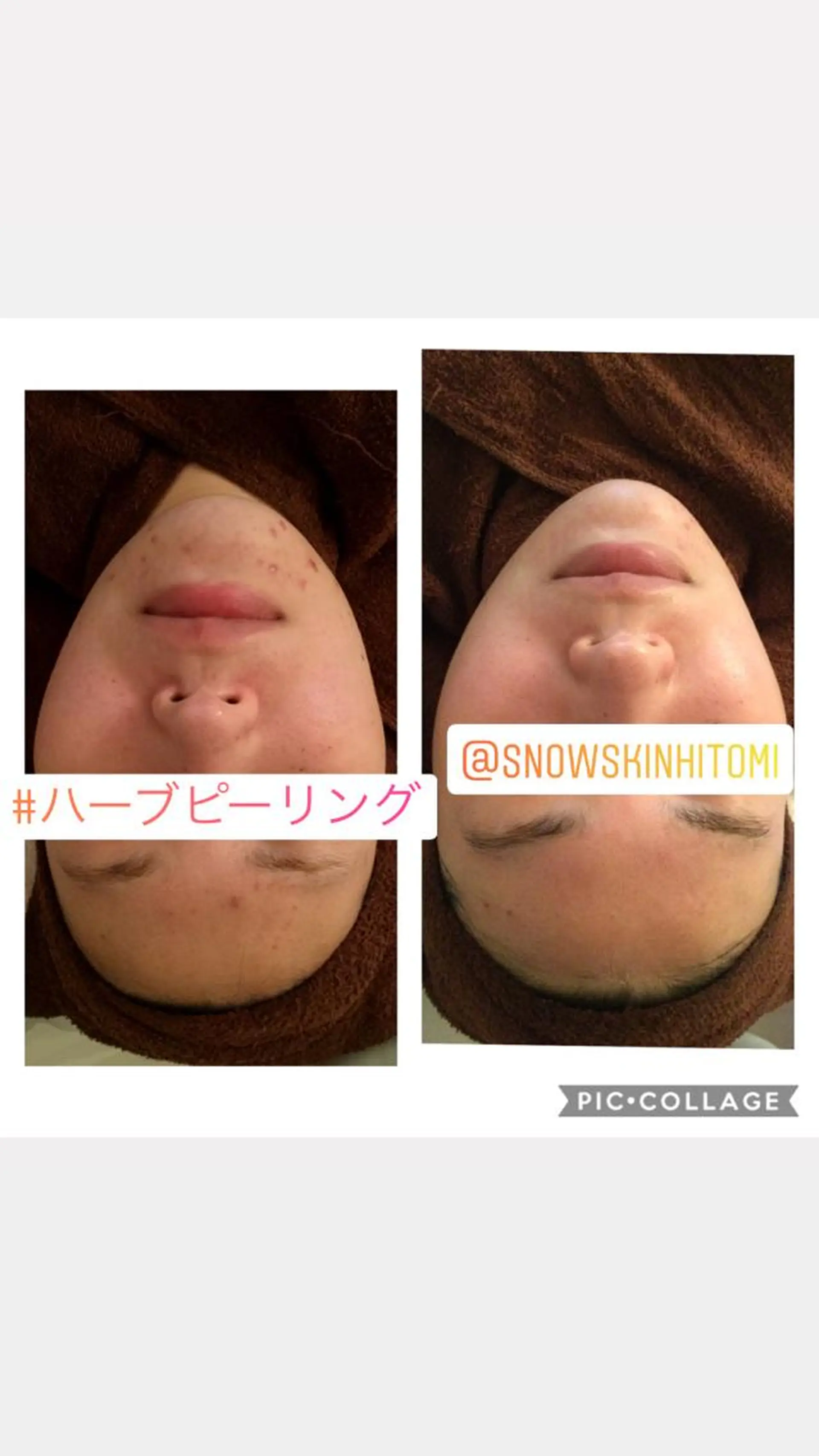 エステ リラク ニキビ/肌質改善専門 Snow skinのエステ・リラクイメージ