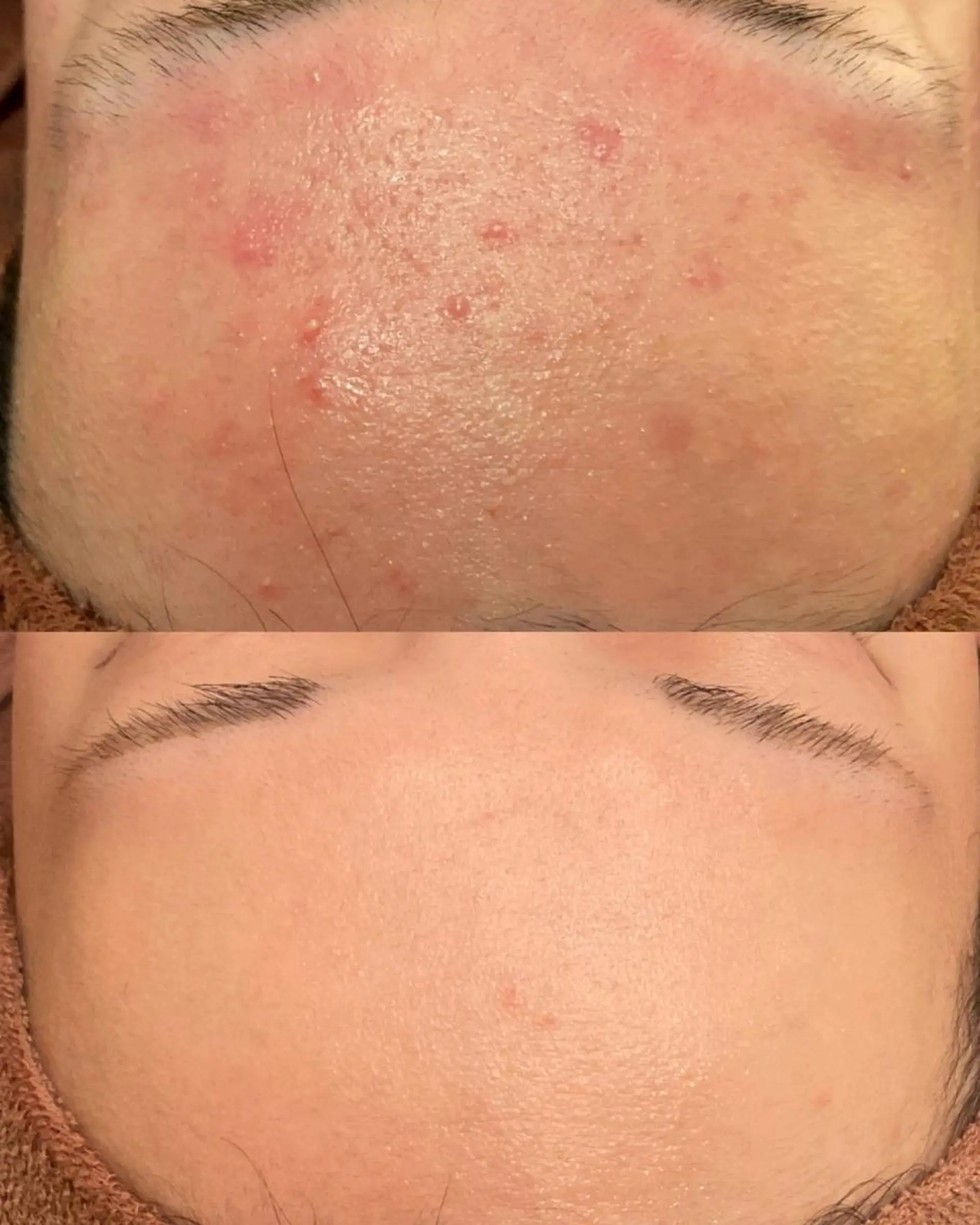 エステ リラク 6万人の美肌実績🔥 最短ニキビ改善のエステ・リラクイメージ