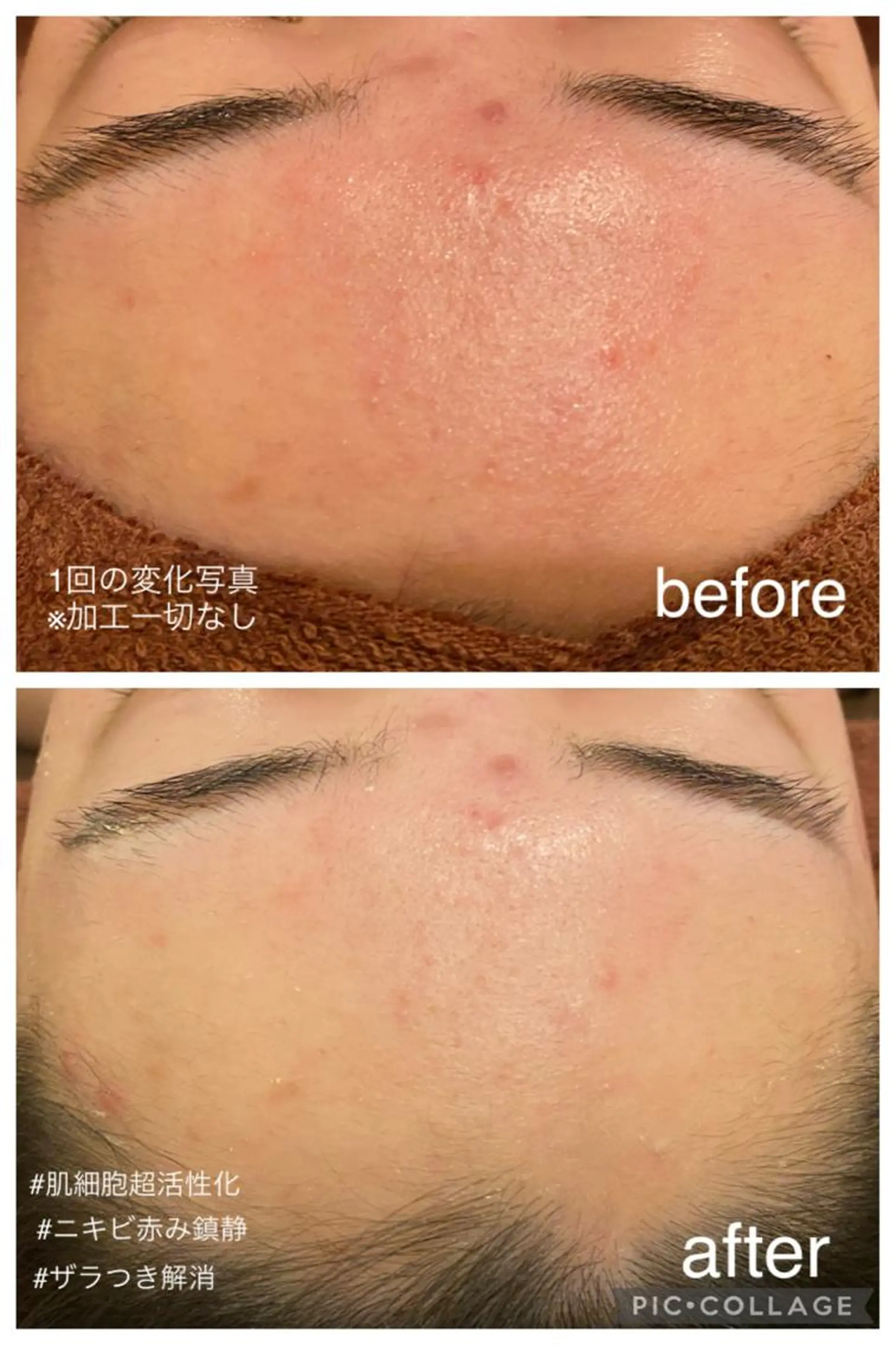 エステ リラク 夏までに肌荒れ卒業 するサロン🌻のエステ・リラクイメージ