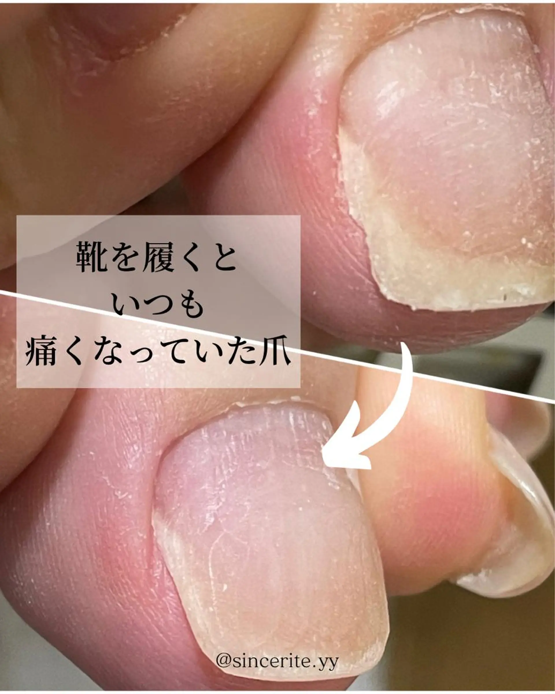 ネイル 深爪・巻き爪 専門サンセリテのネイルデザイン