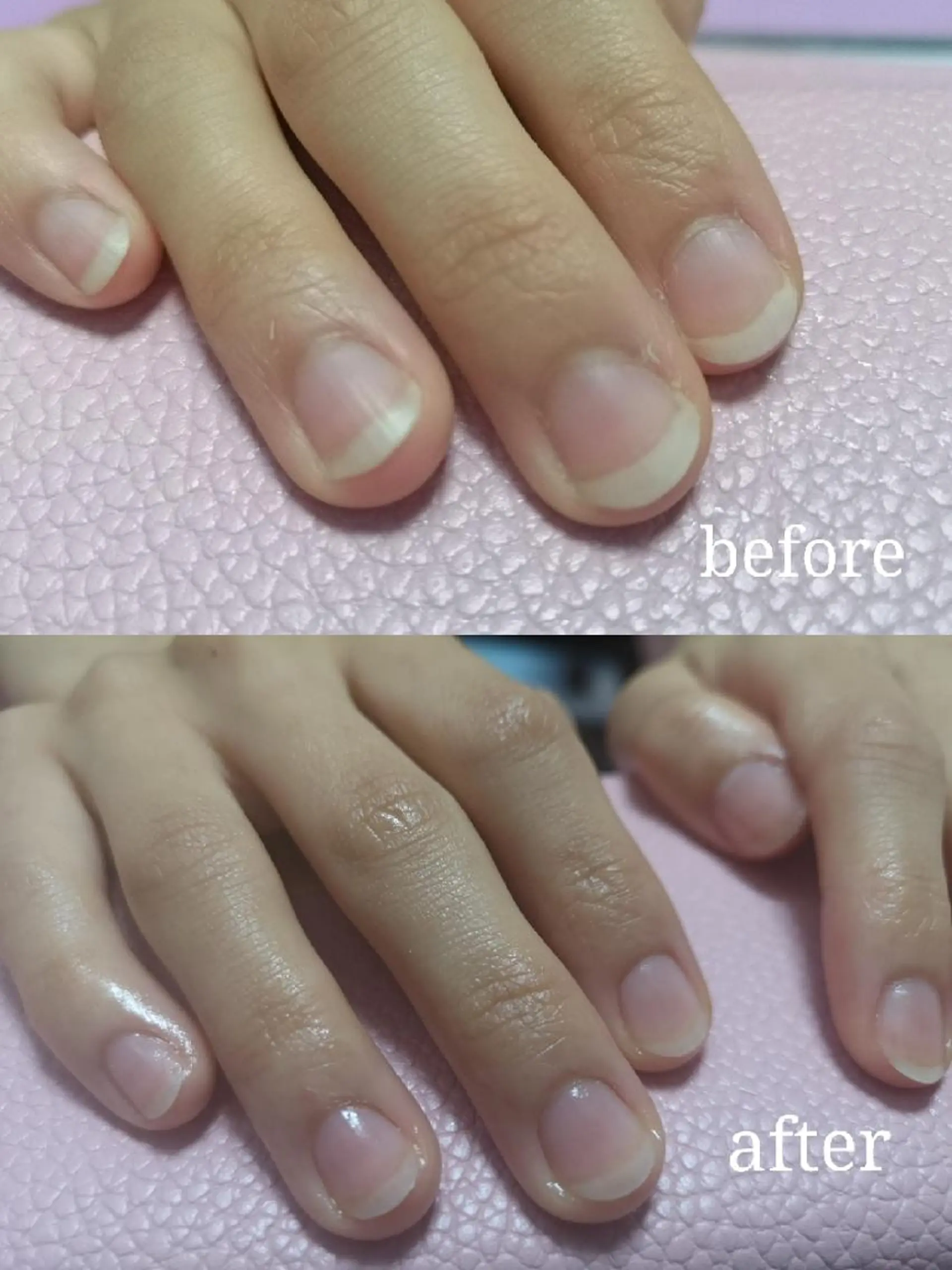 ネイル ネイリストゆか💅 長さだし、深爪矯正のネイルデザイン