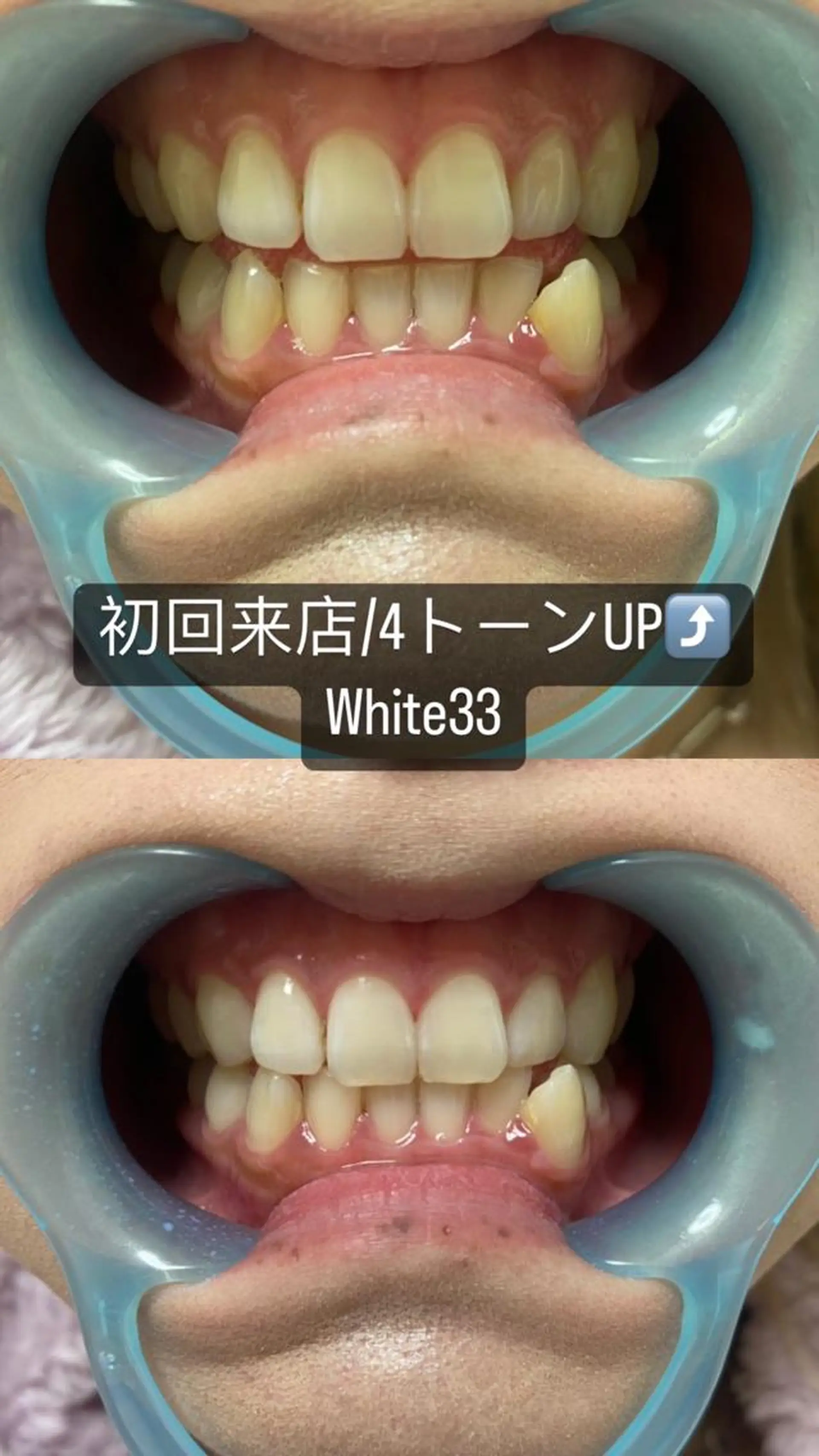 メンズ アイブロウ セルフホワイトニング White33大名のその他イメージ