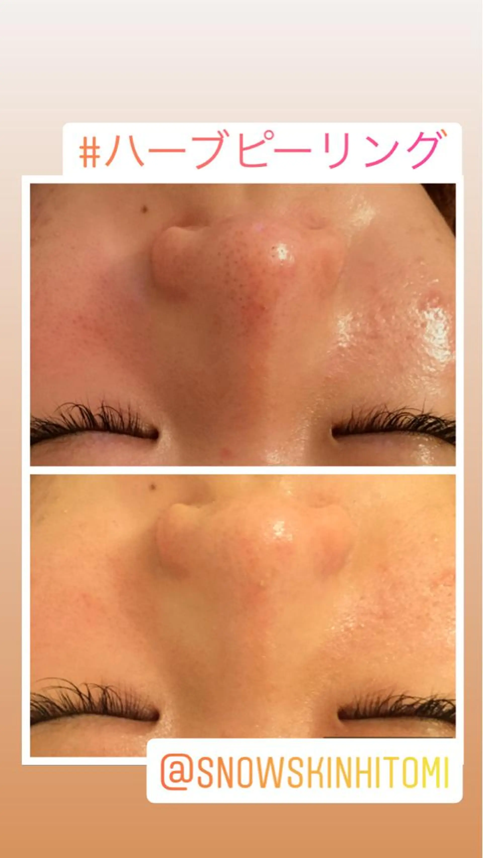 エステ リラク ニキビ/肌質改善専門 Snow skinのエステ・リラクイメージ