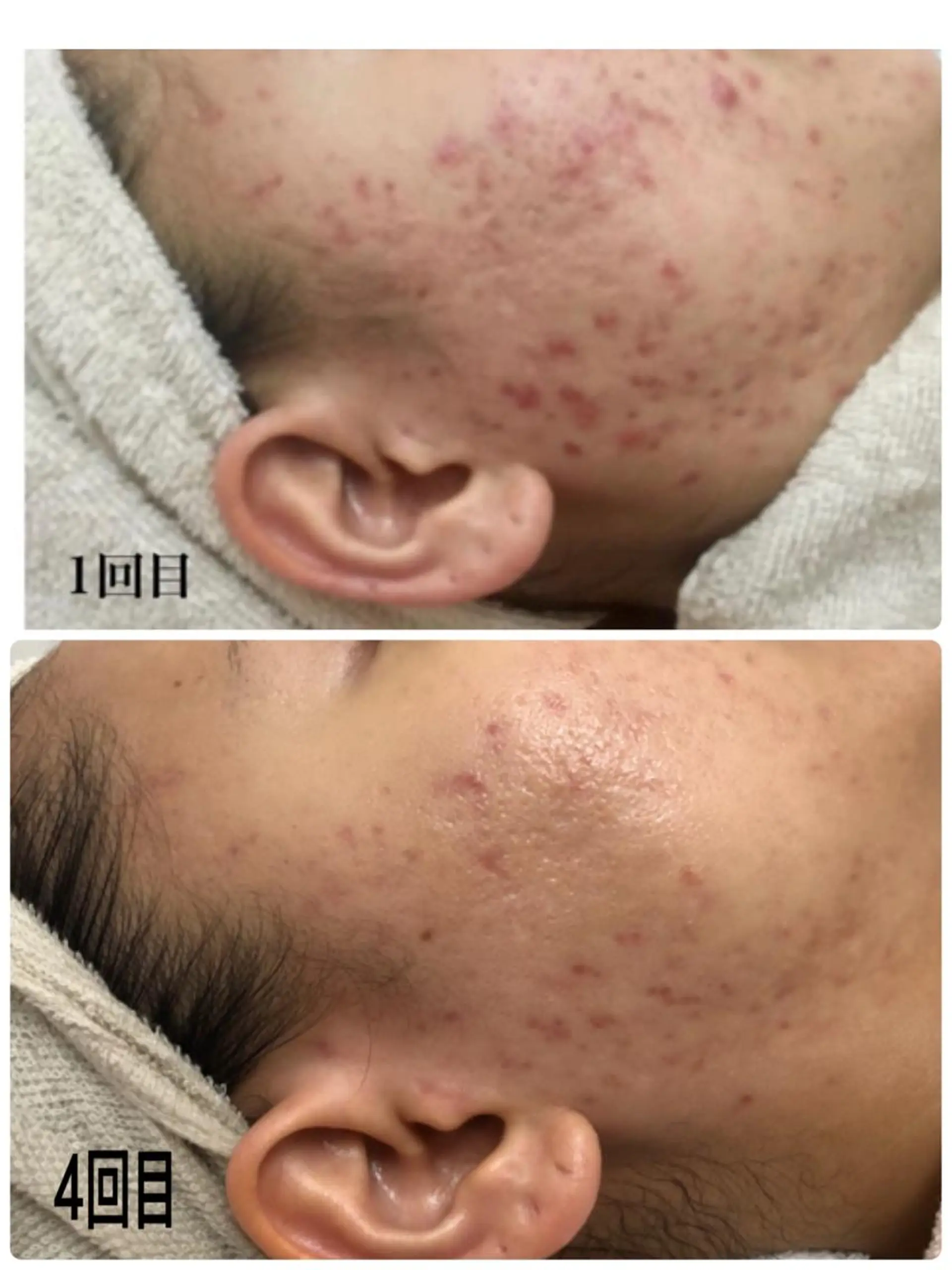 Meupニキビ専門店 背中/ハーブ/肌管理のその他イメージ