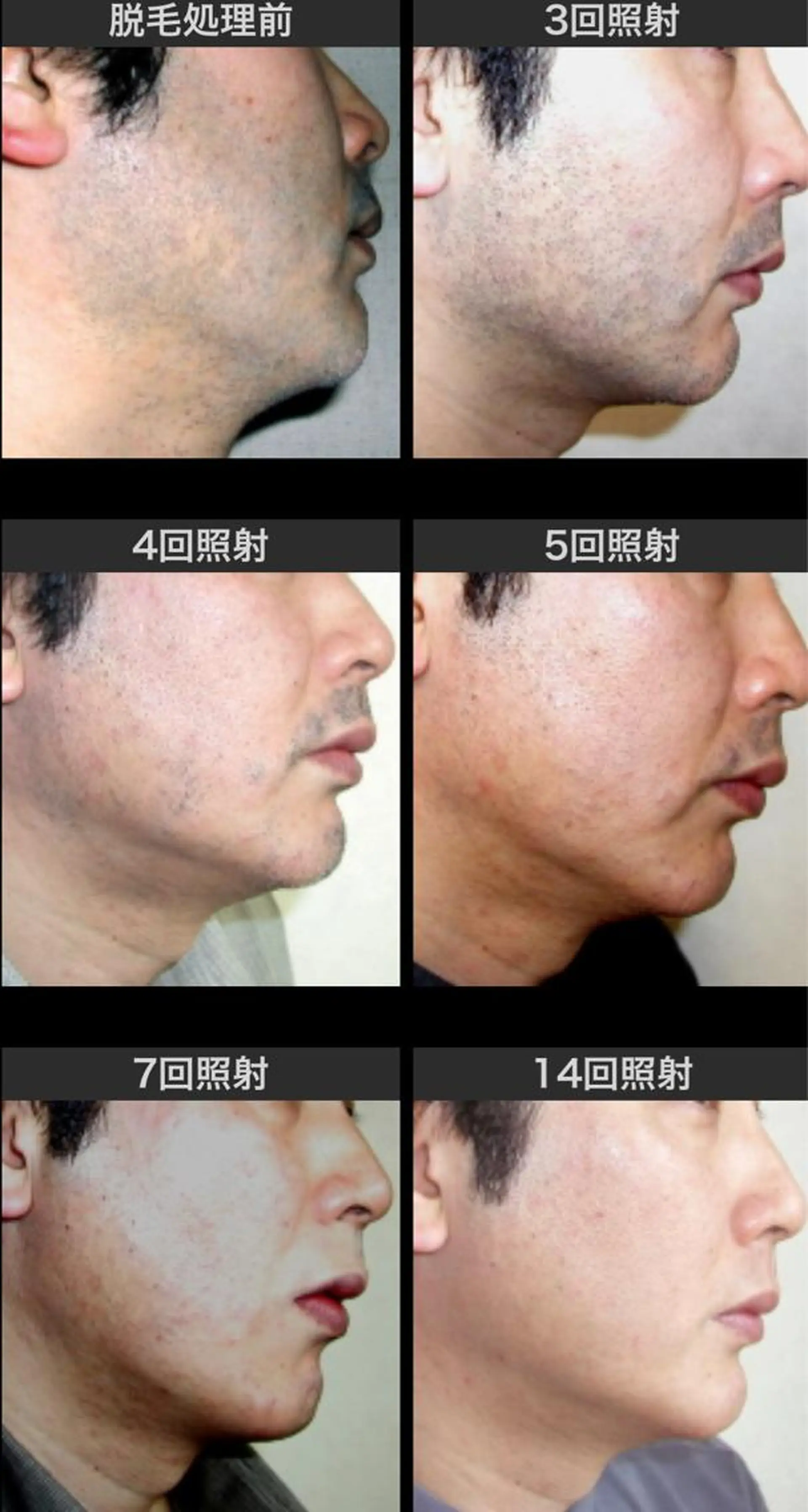 メンズ 脱毛 都度払い脱毛⭐️ 脱毛サロンMIRACのエステ・リラクイメージ